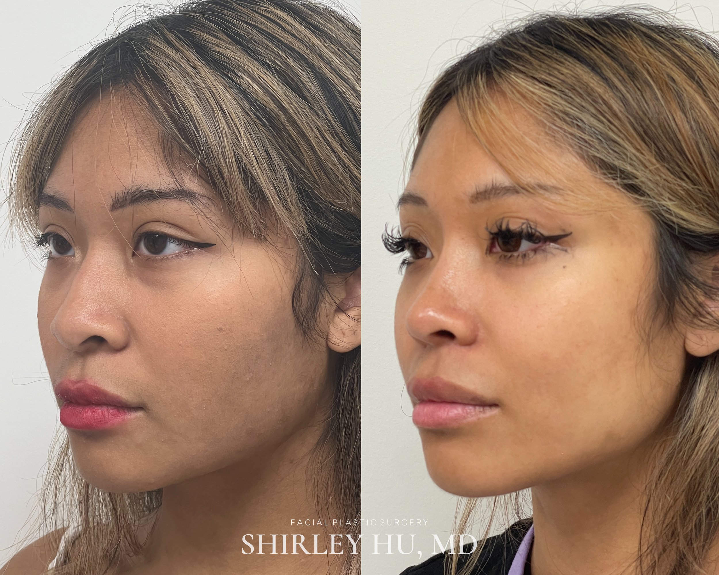 Primary rhinoplasty in a 22-year-old woman