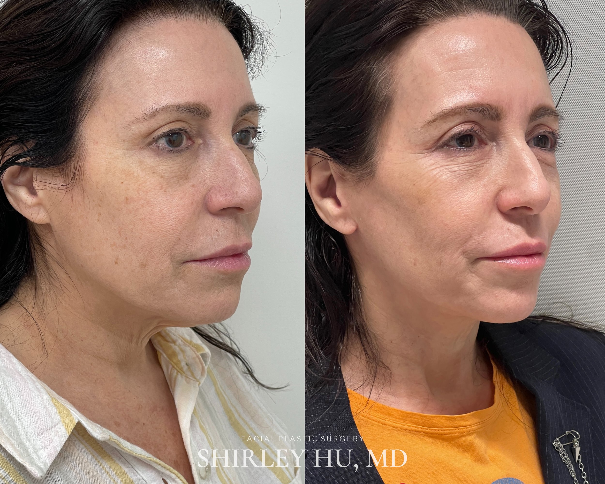 Extended neck lift in a 59-year-old woman