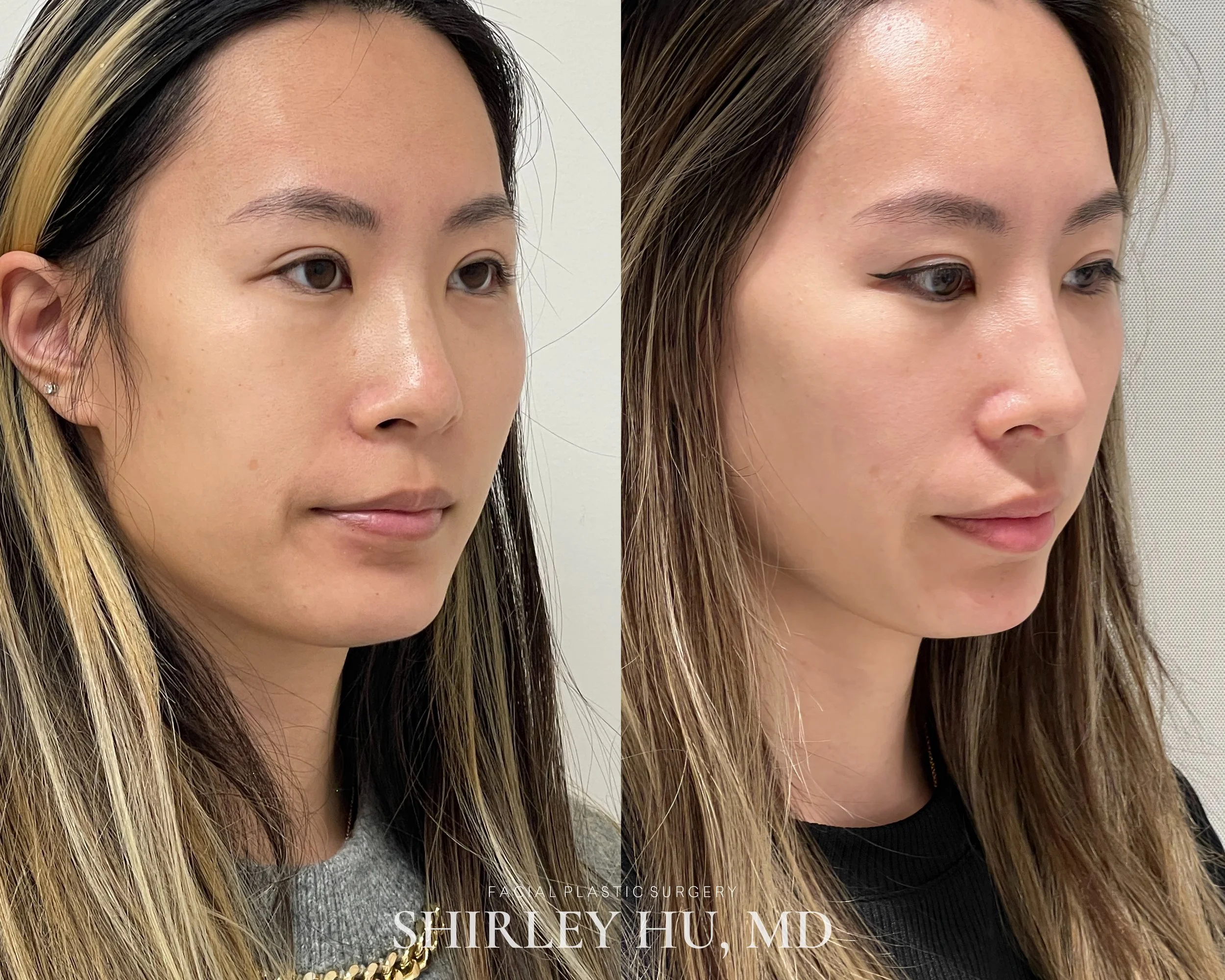 Primary rhinoplasty with septal cartilage in a 26-year-old woman