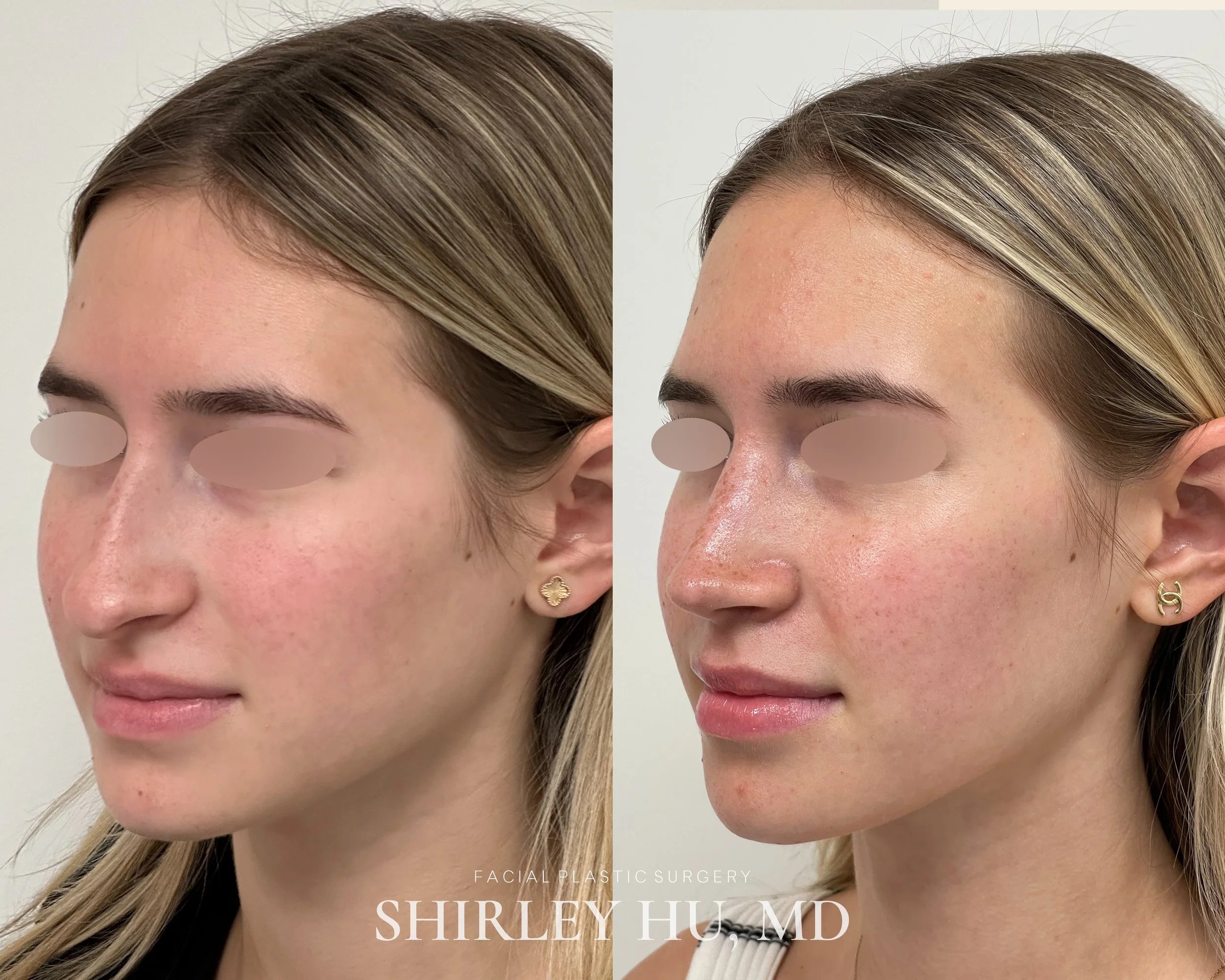 Primary rhinoplasty in a 20-year-old woman