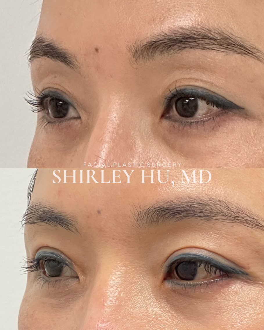 Upper blepharoplasty with crease formation and lower blepharoplasty in a 46-year-old woman