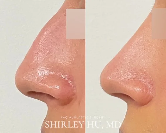 Primary rhinoplasty in a 26-year-old woman