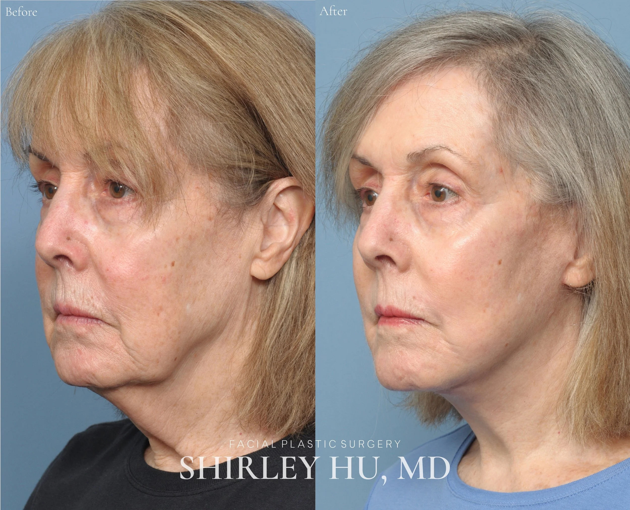 Facelift, neck lift, and perioral laser resurfacing in a 68-year-old woman