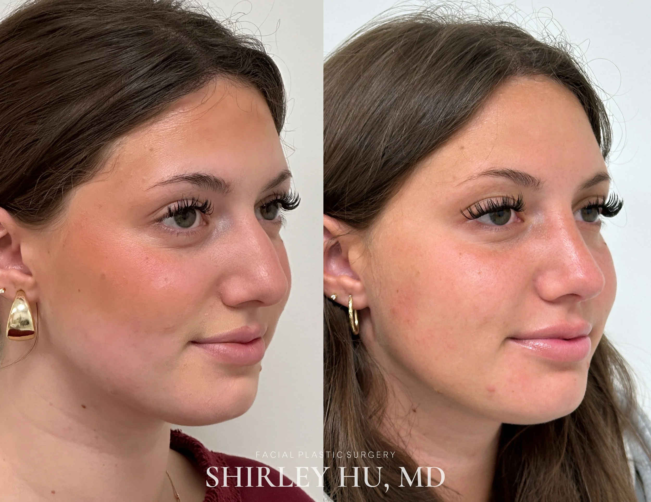 Primary rhinoplasty in a 20-year-old woman