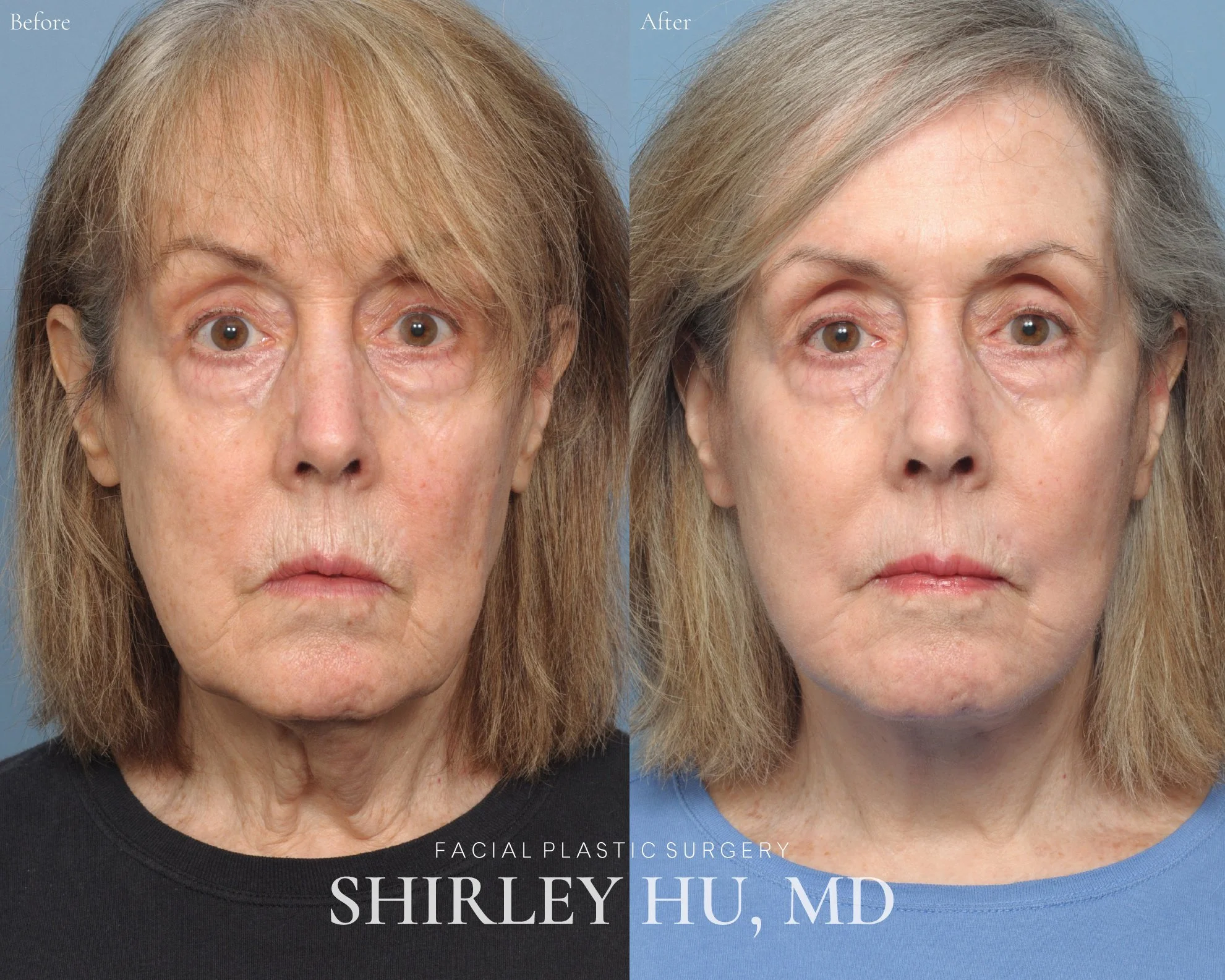 Facelift, neck lift, and perioral laser resurfacing in a 68-year-old woman