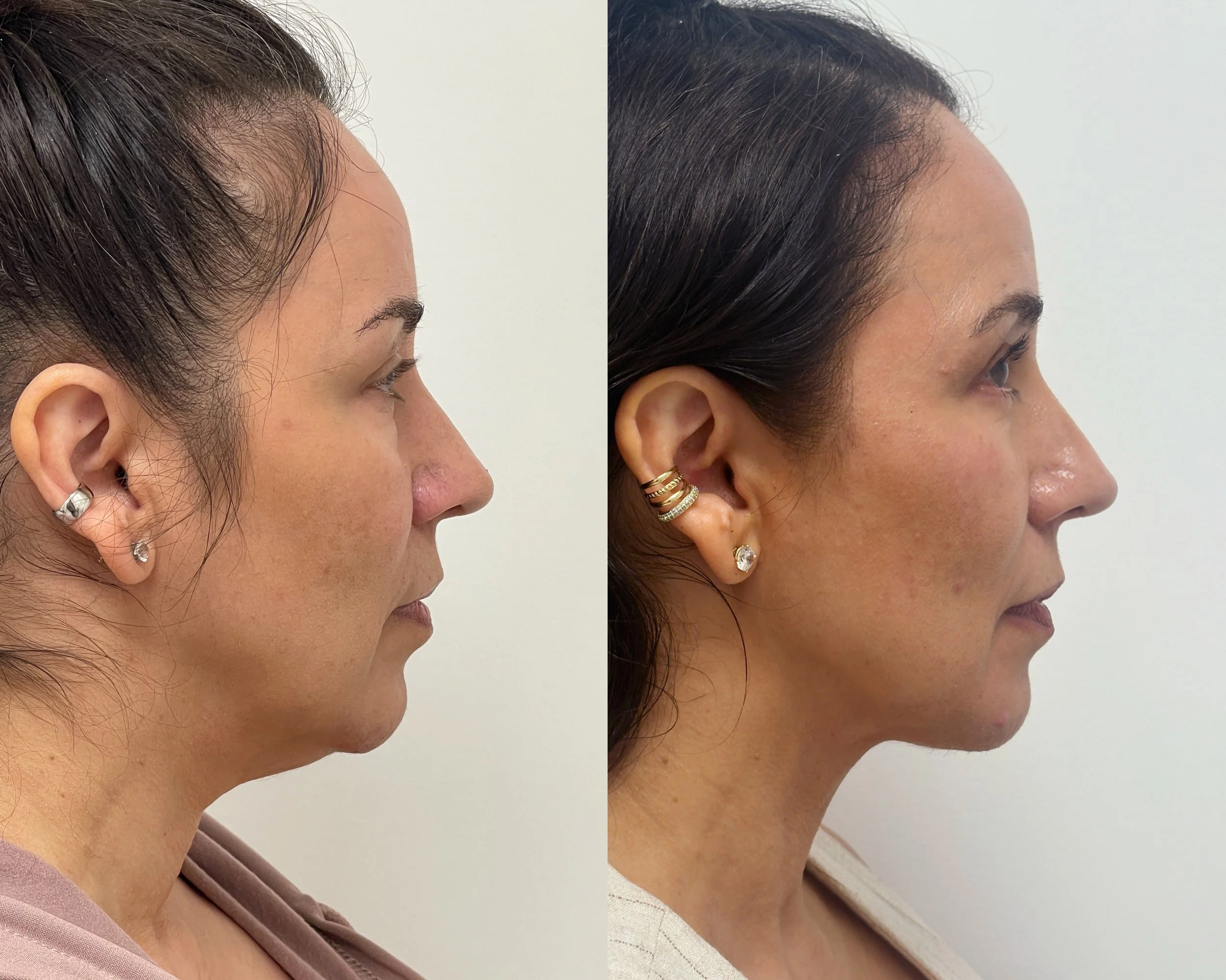 Deep neck lift, liposuction, and Renuvion skin tightening in a 54-year-old woman