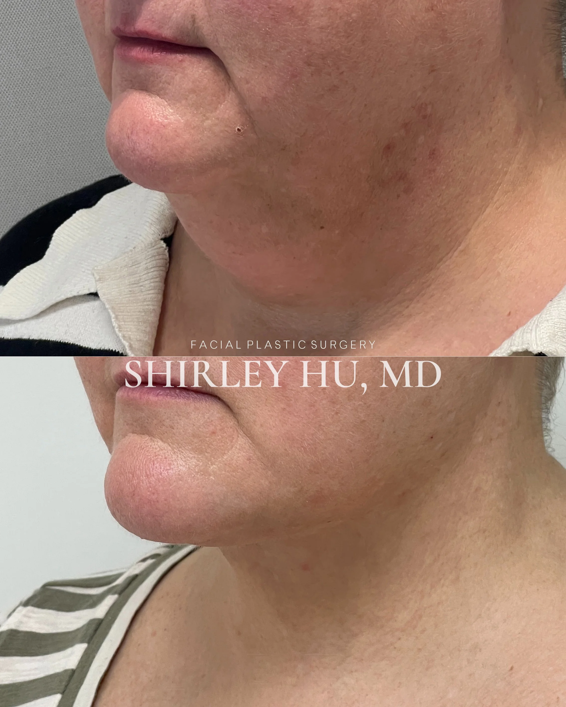 Extended deep plane face and neck lift in a 58-year-old woman