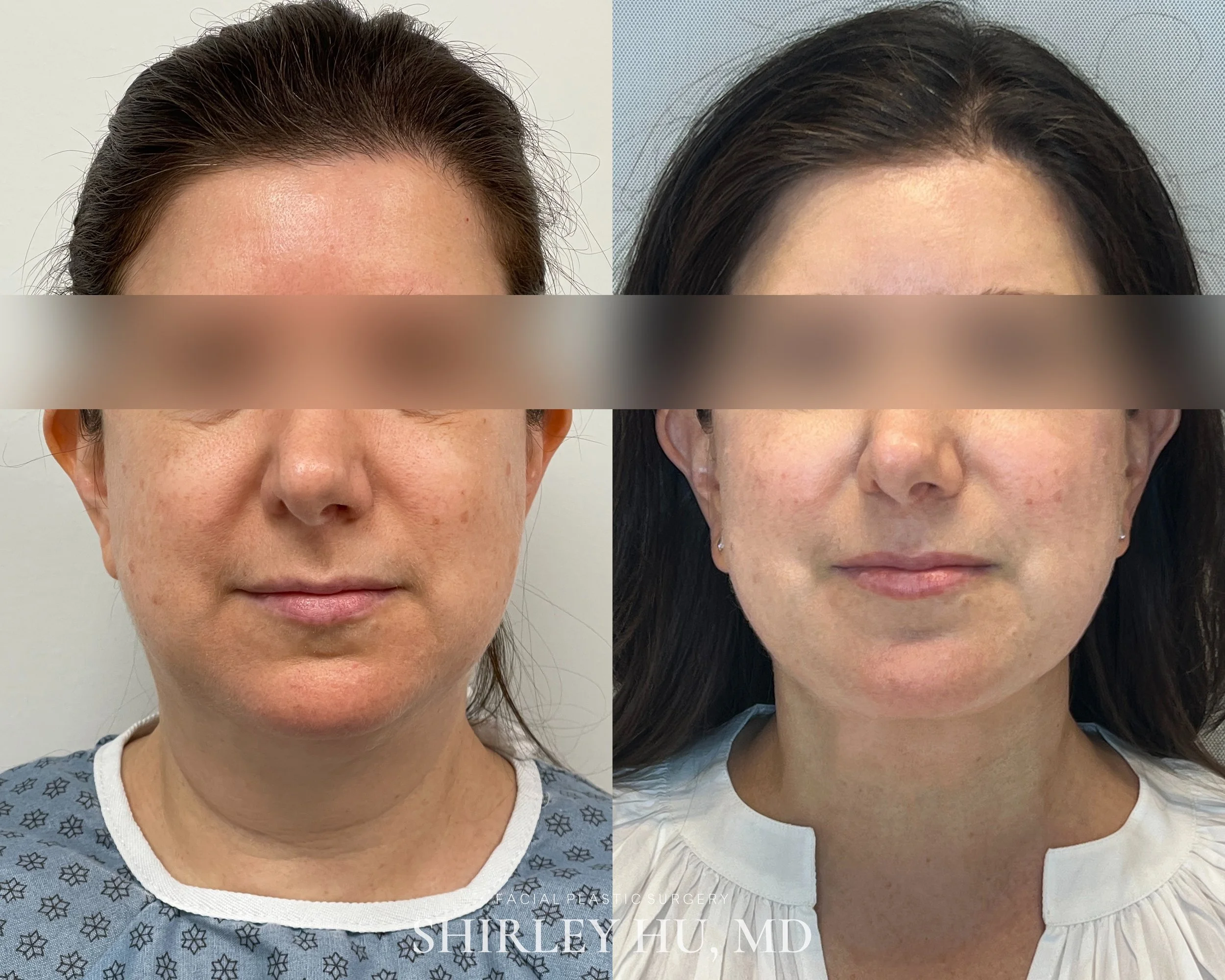 Deep neck lift, liposuction, and Renuvion skin tightening in a 52-year-old woman