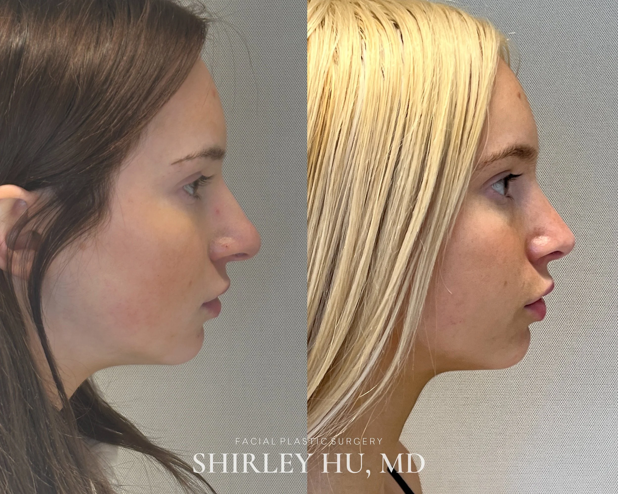 Primary rhinoplasty in an 18-year-old woman