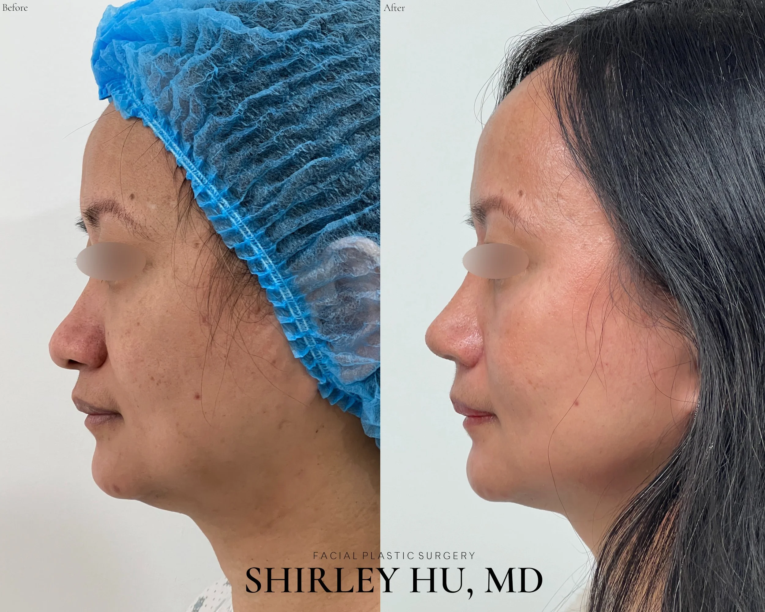 Primary rhinoplasty with rib cartilage in a 45-year-old woman