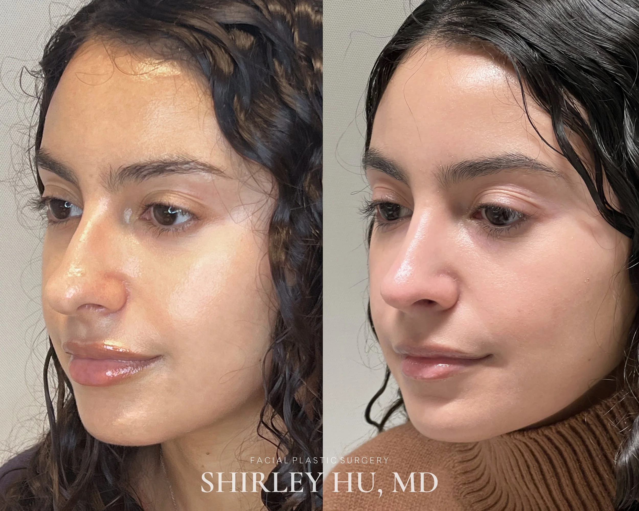 Primary rhinoplasty in a 30-year-old woman
