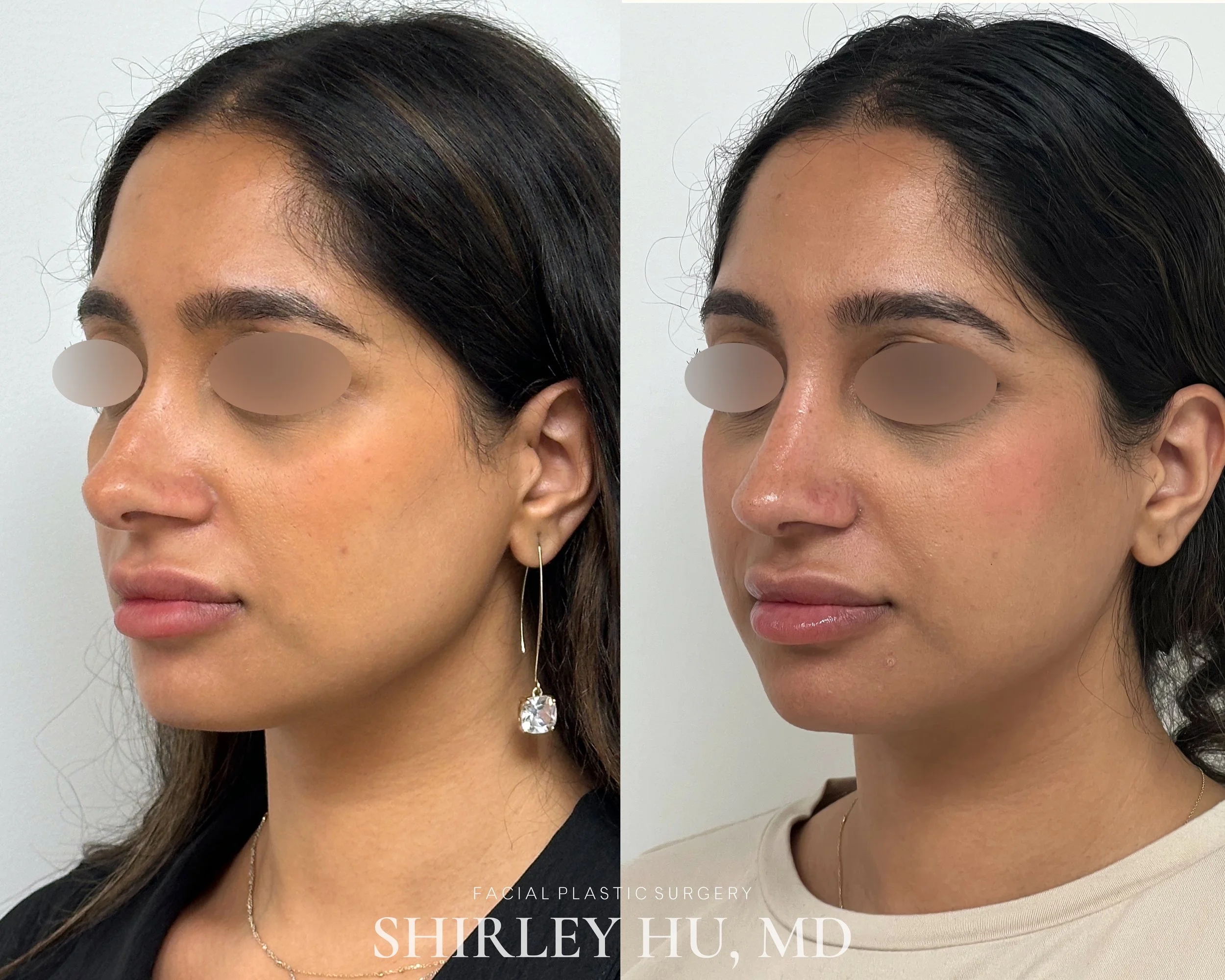 Primary rhinoplasty in a 30-year-old woman