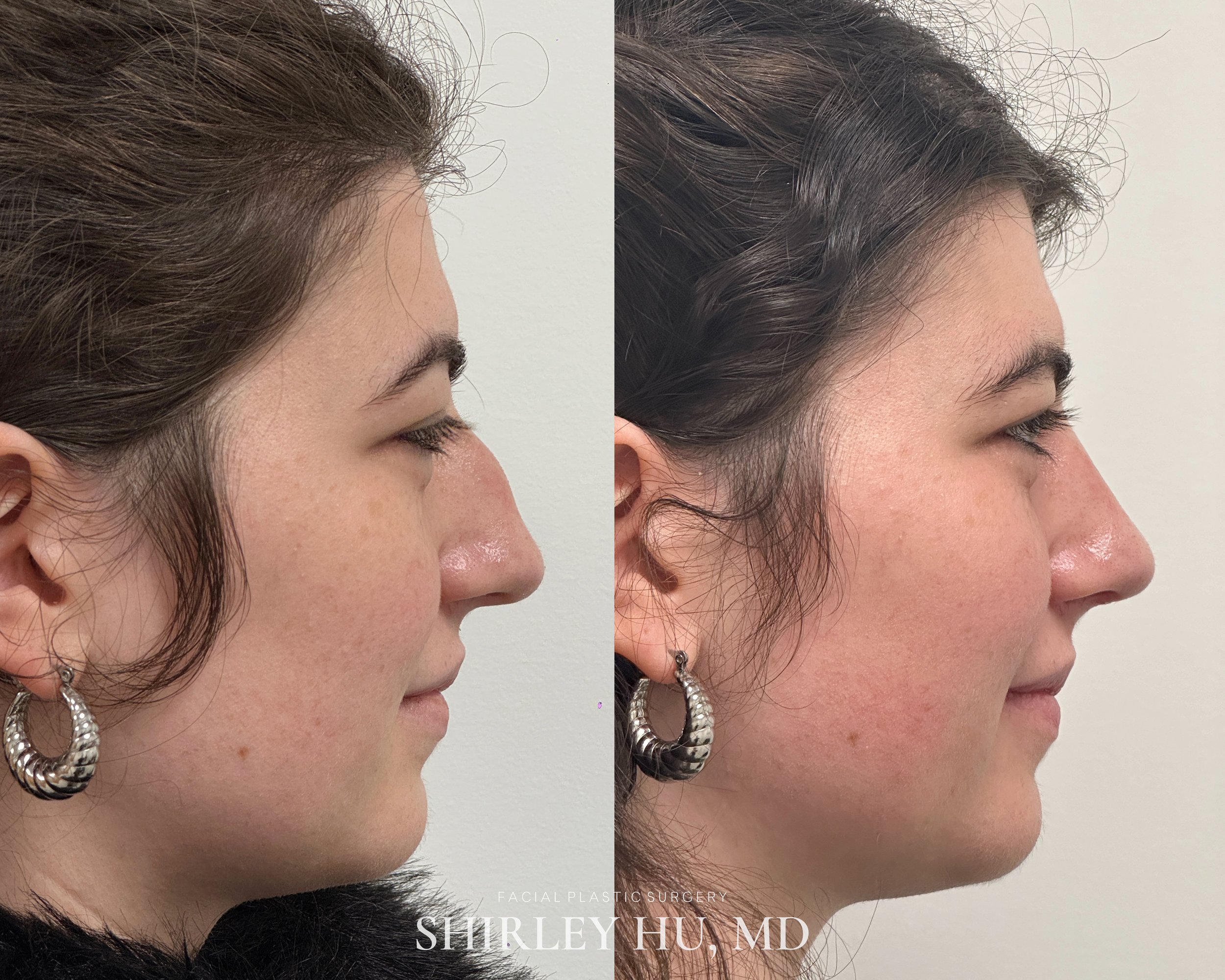 Primary rhinoplasty in a 29-year-old woman