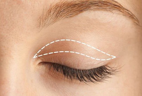 Blepharoplasty (Eyelid Lift)