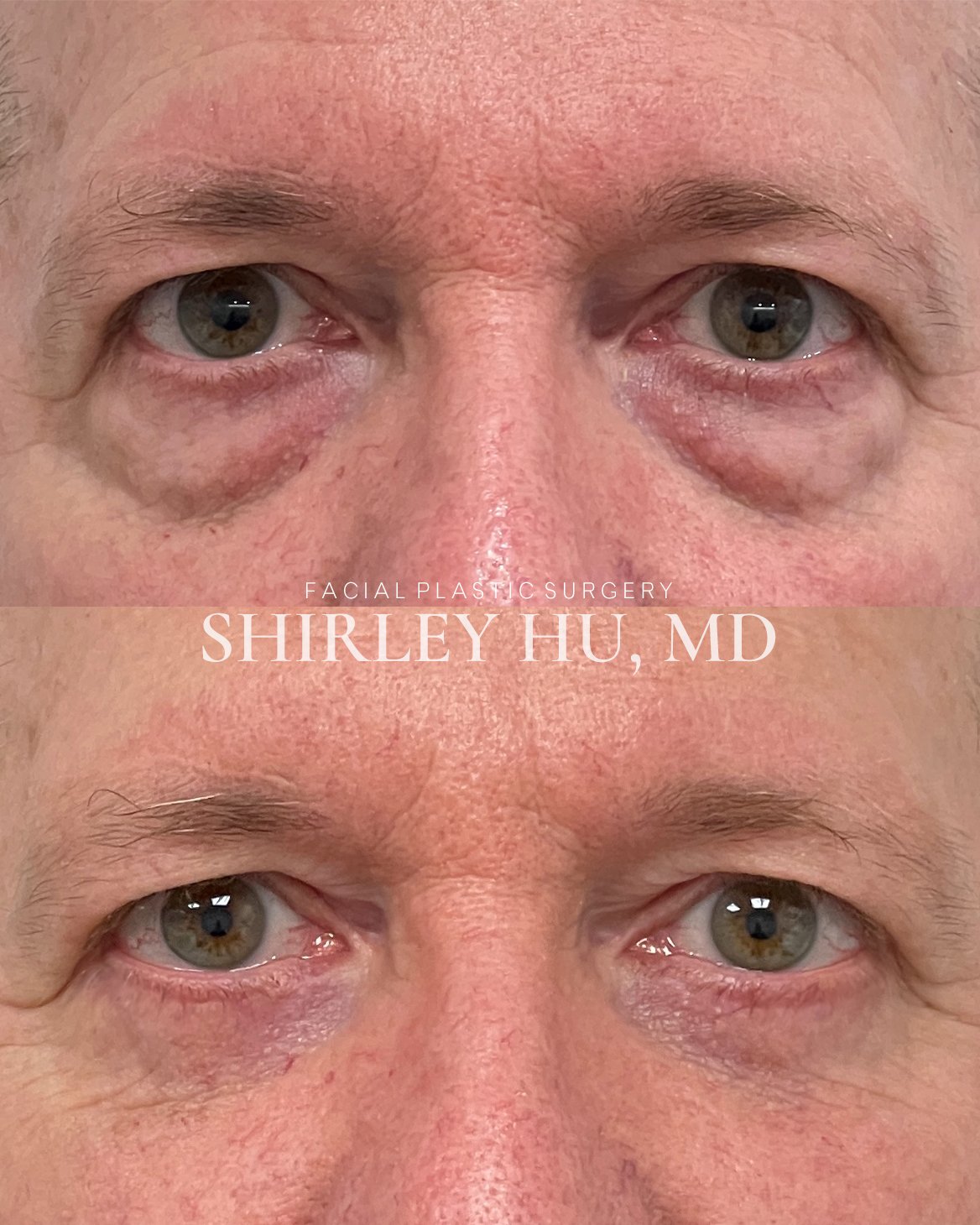 Lower blepharoplasty in a 63-year-old man