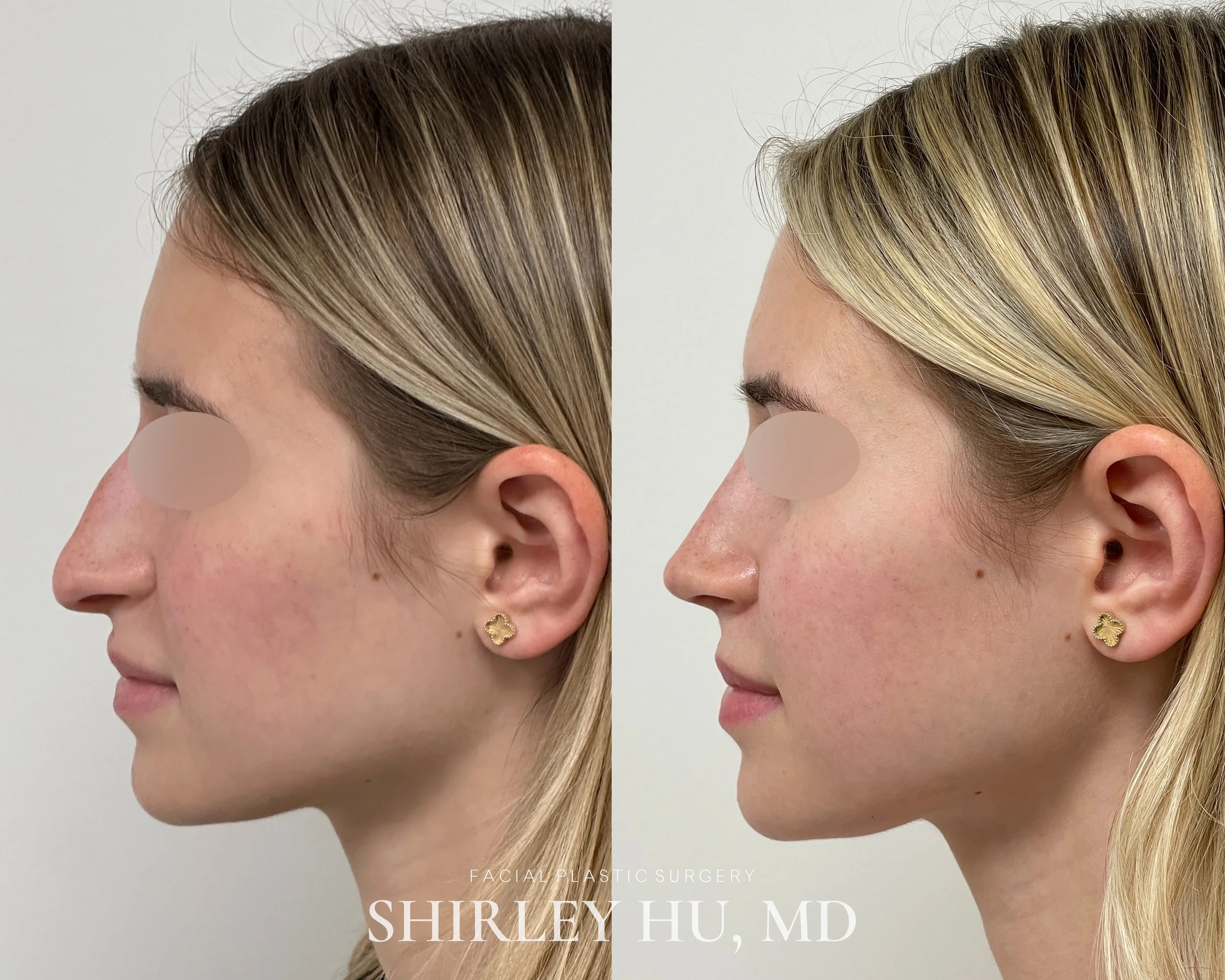 Primary rhinoplasty in a 20-year-old woman