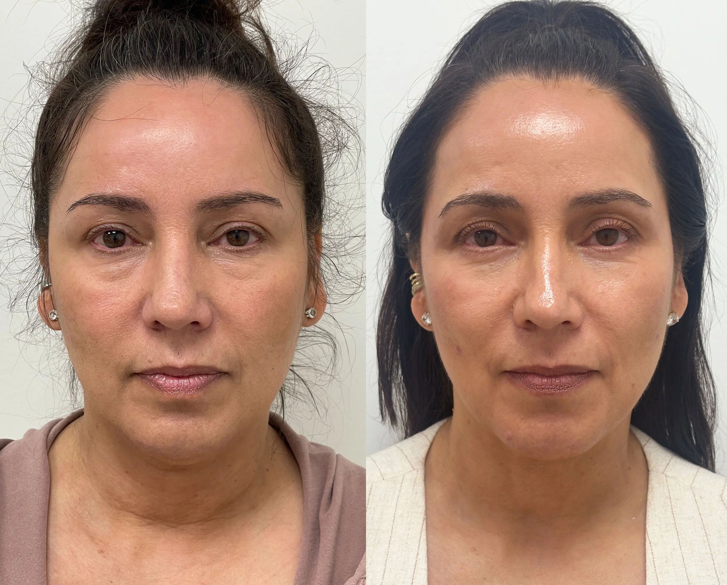 Deep neck lift, liposuction, and Renuvion skin tightening in a 54-year-old woman