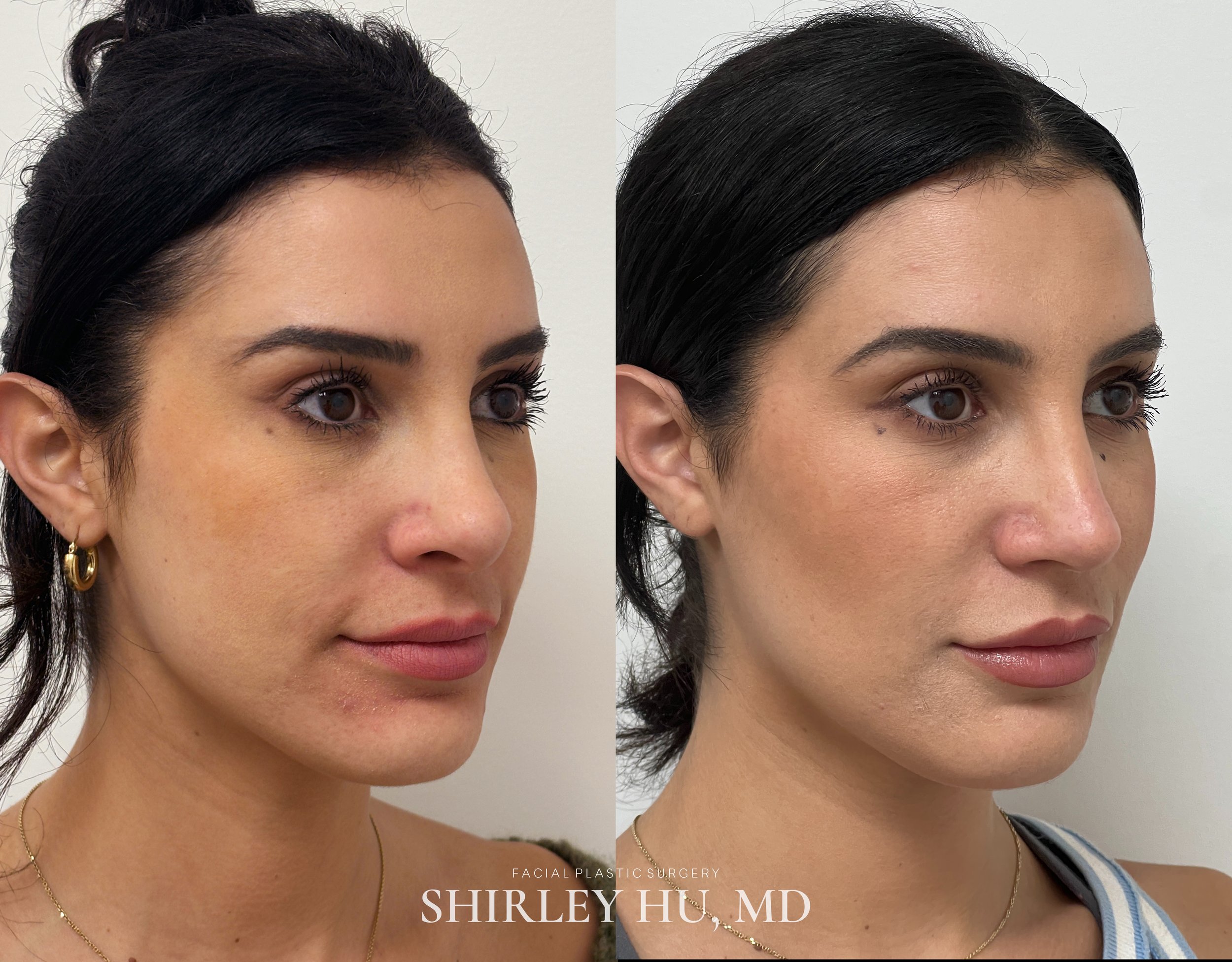Revision rhinoplasty in a 30-year-old woman