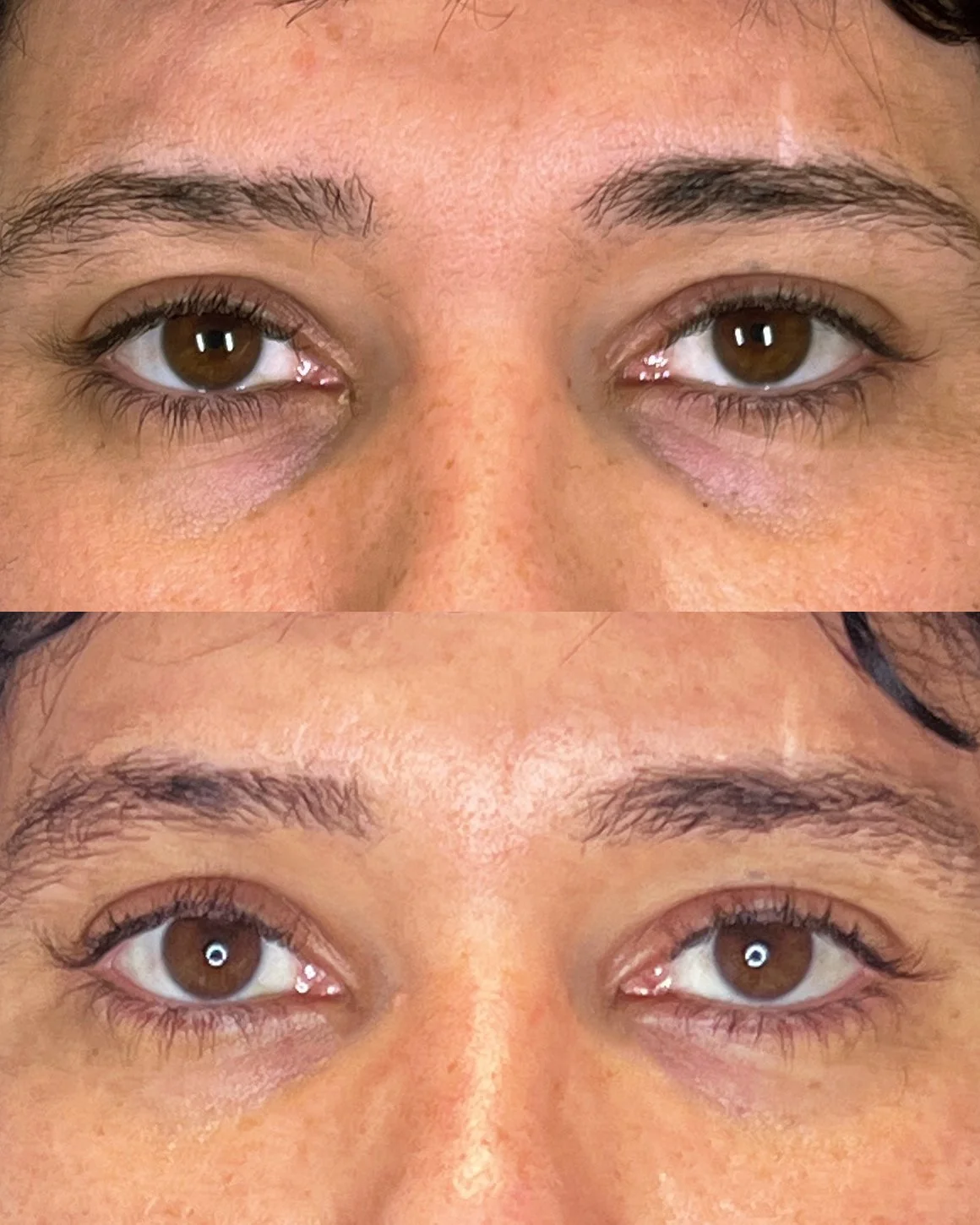 Microfat and nanofat grafting to lower lids