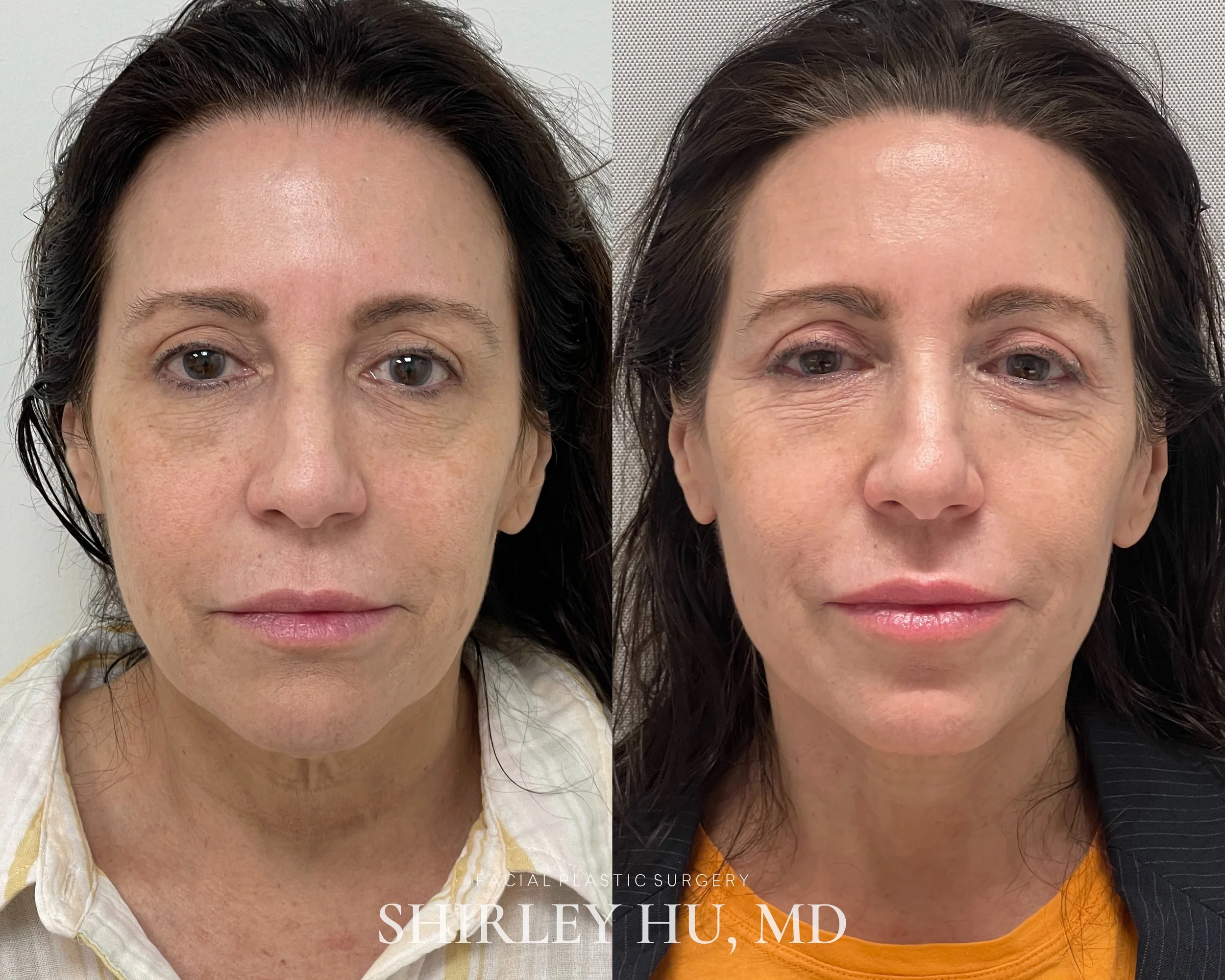 Extended neck lift in a 59-year-old woman