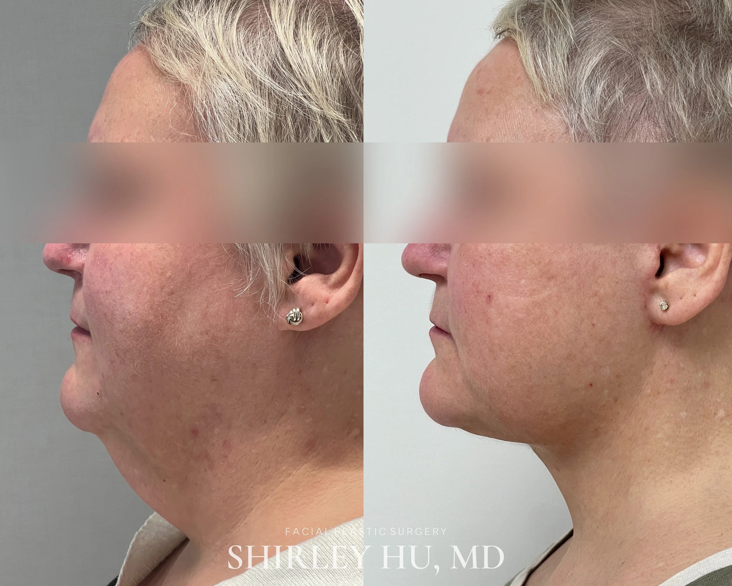 Extended deep plane face and neck lift in a 55-year-old woman