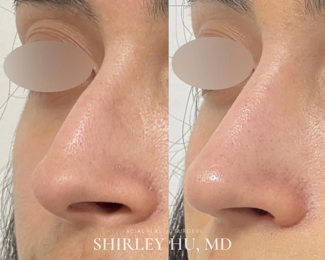 Primary rhinoplasty in a 26-year-old woman
