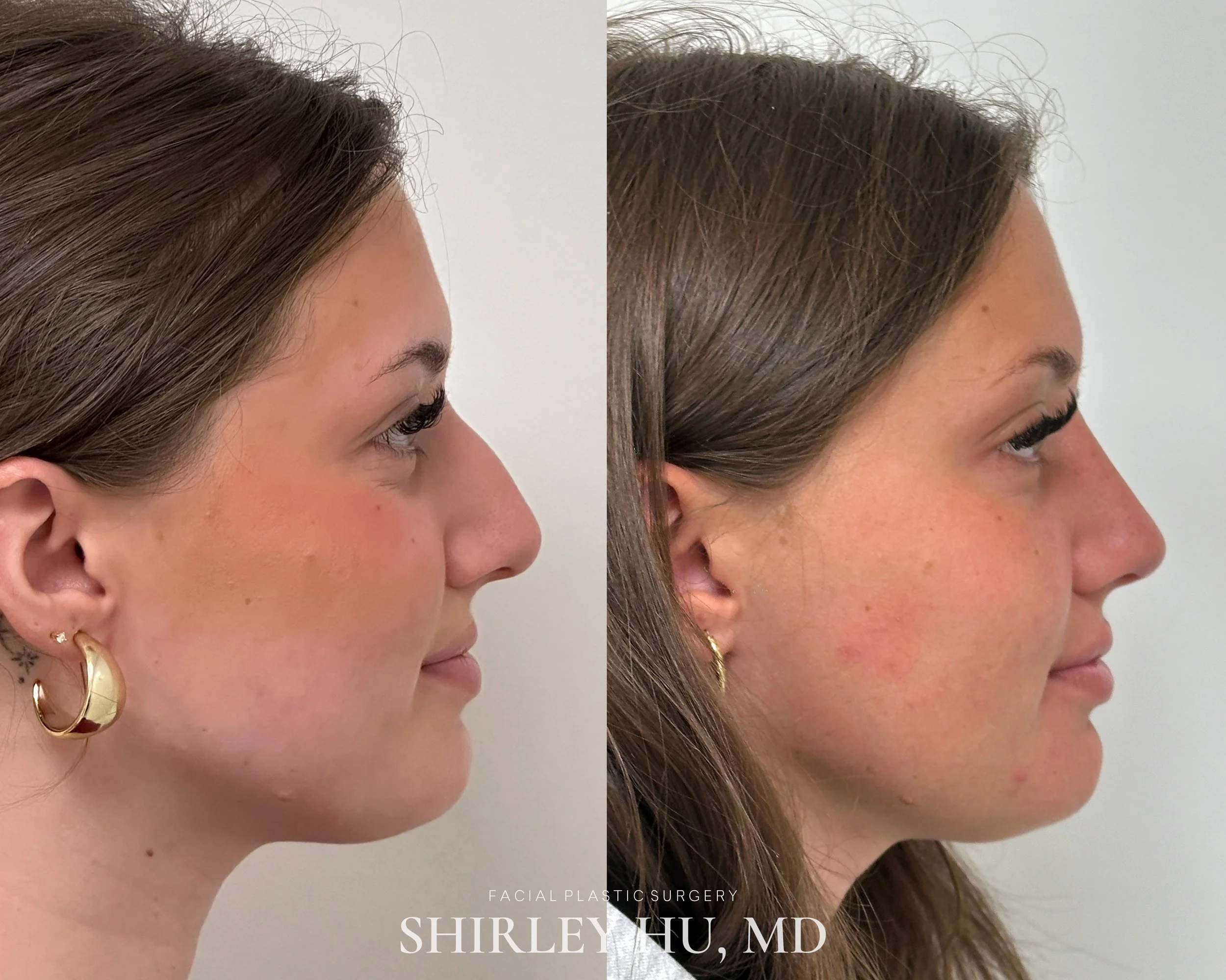 Primary rhinoplasty in a 20-year-old woman