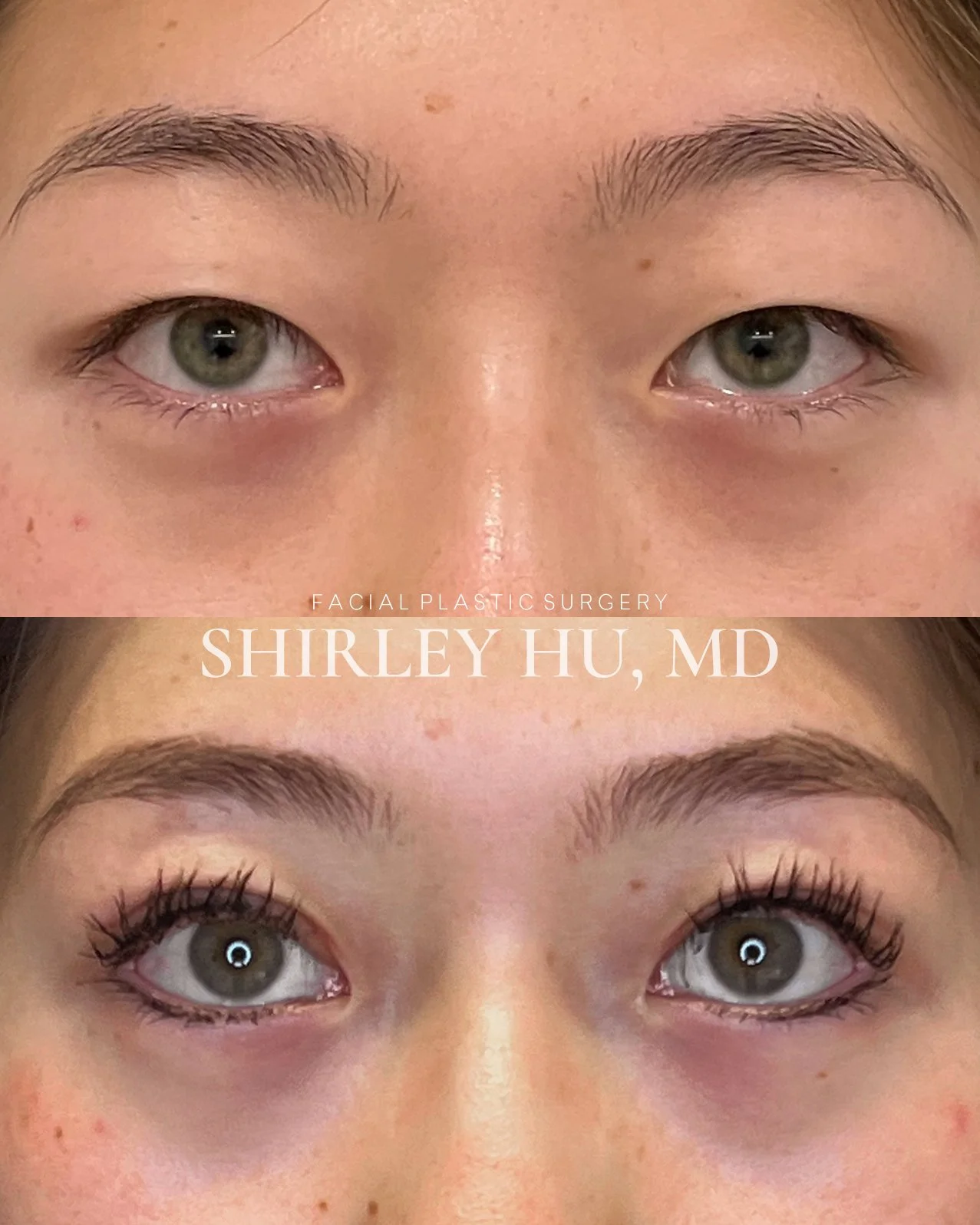 Incisional double eyelid surgery in an 18-year-old female