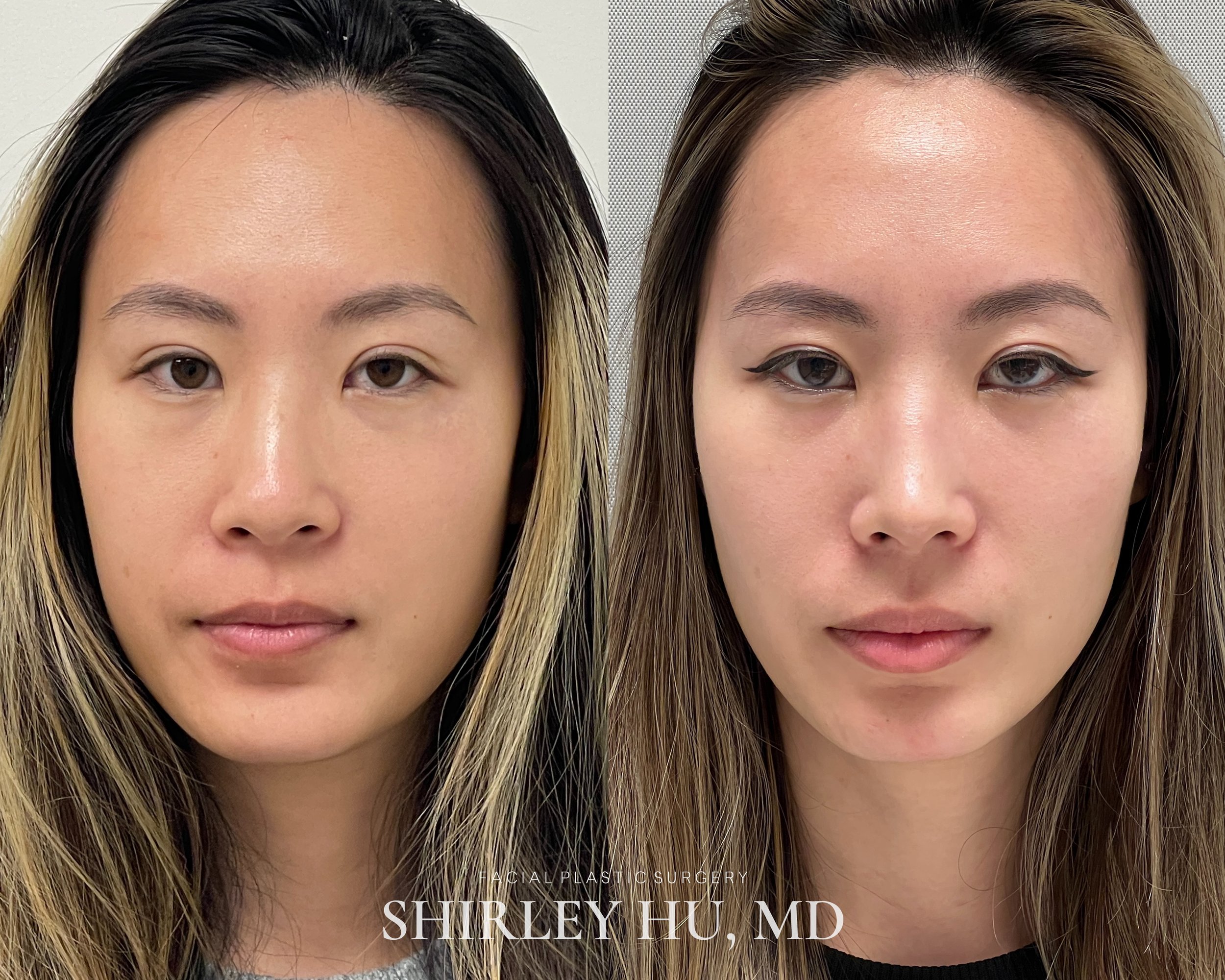 Primary rhinoplasty with septal cartilage in a 26-year-old woman