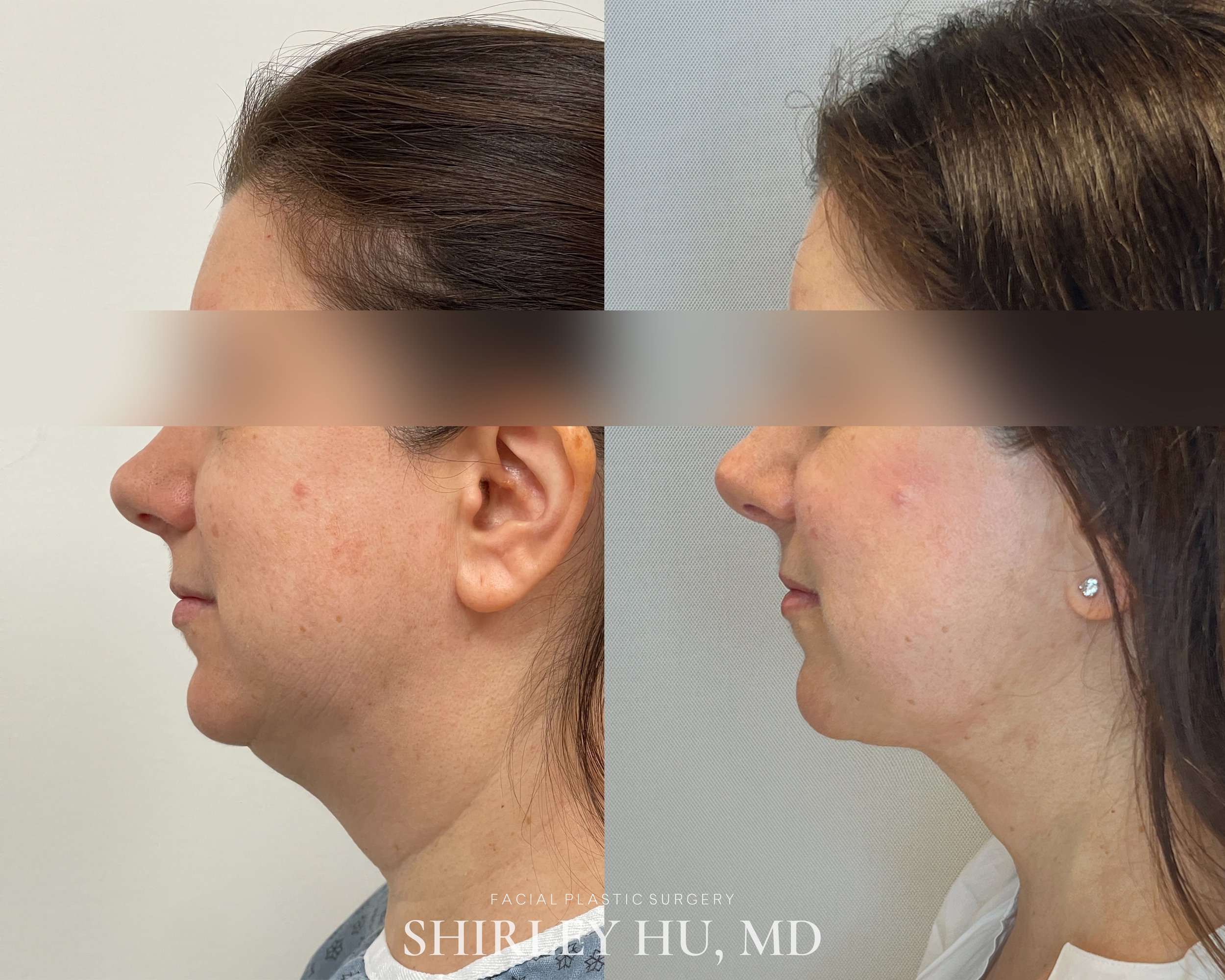Deep neck lift, liposuction, and Renuvion skin tightening in a 52-year-old woman