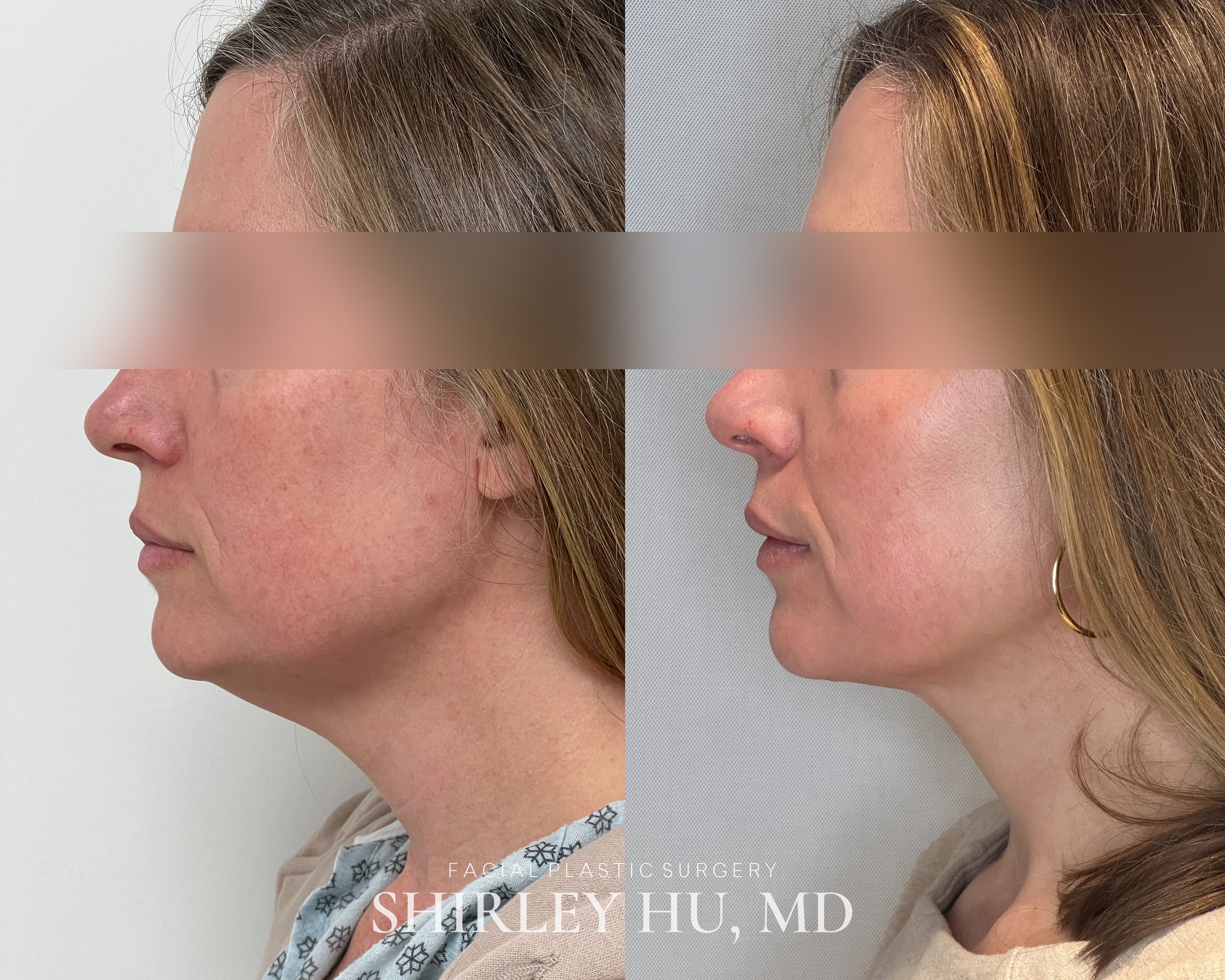Deep neck lift, liposuction, and Renuvion neck skin tightening in a 46-year-old woman