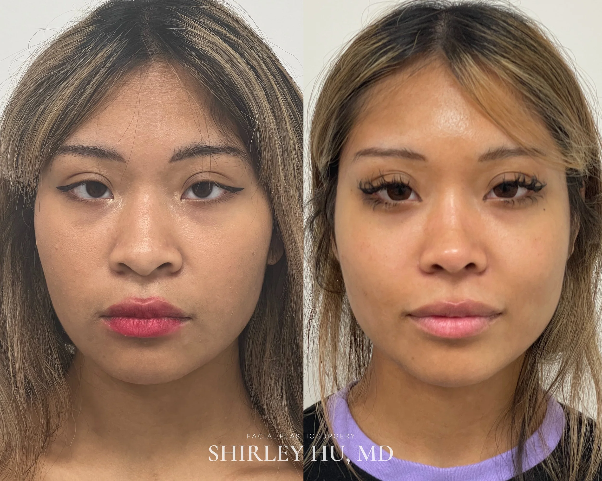 Primary rhinoplasty in a 22-year-old woman