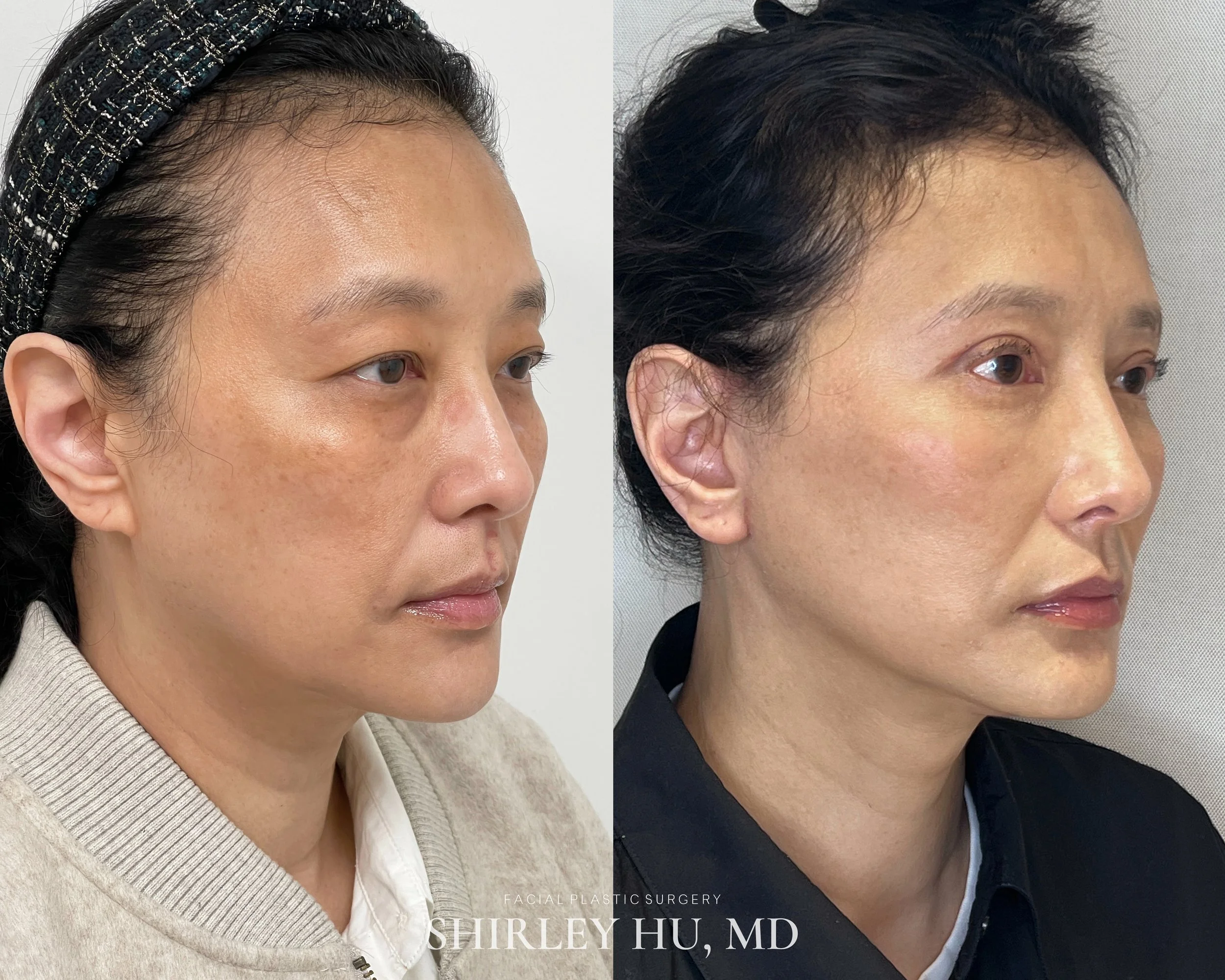 Facelift, neck lift, upper blepharoplasty, and lower blepharoplasty in a 49-year-old woman