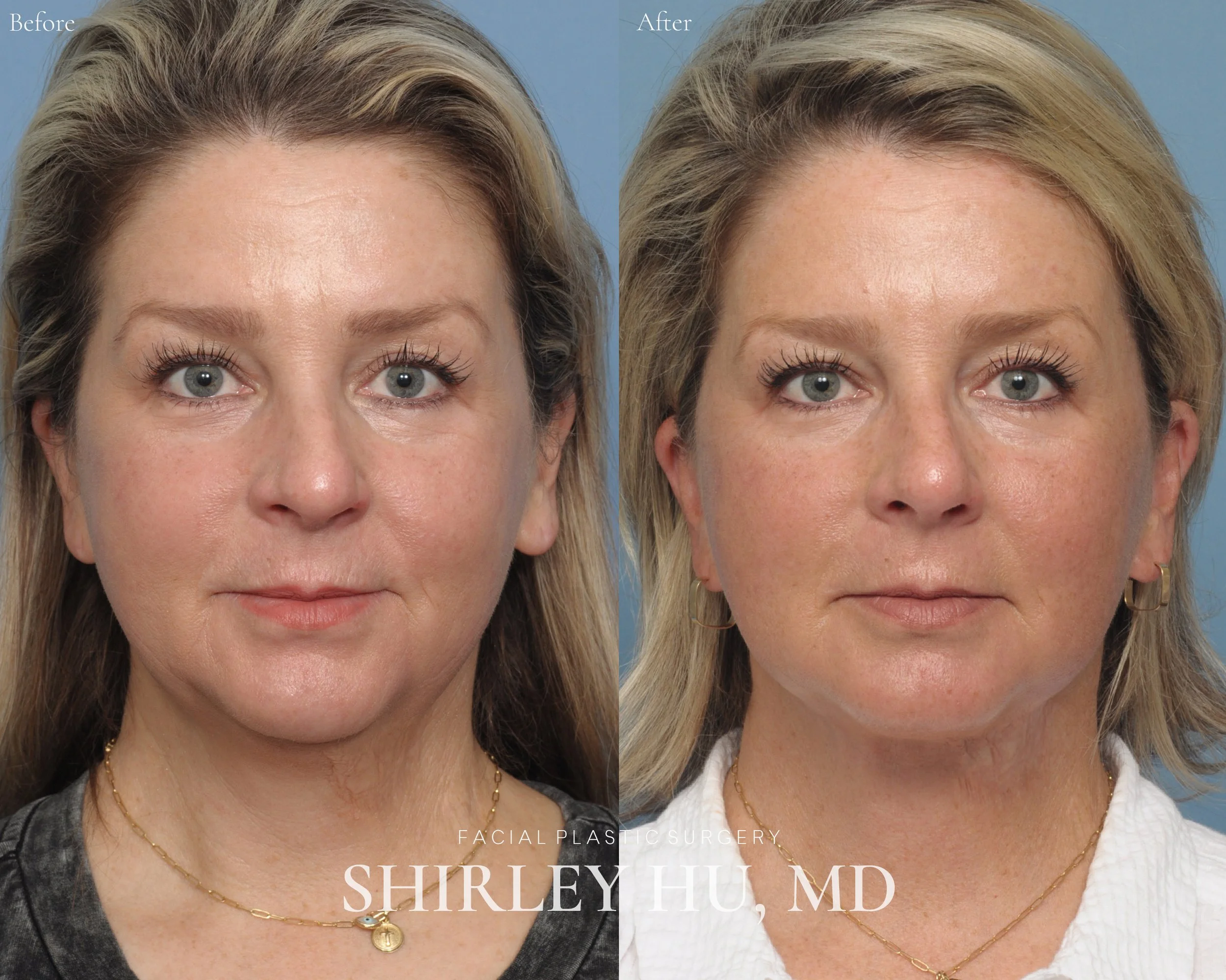 Extended deep plane face and neck lift in a 52-year-old woman