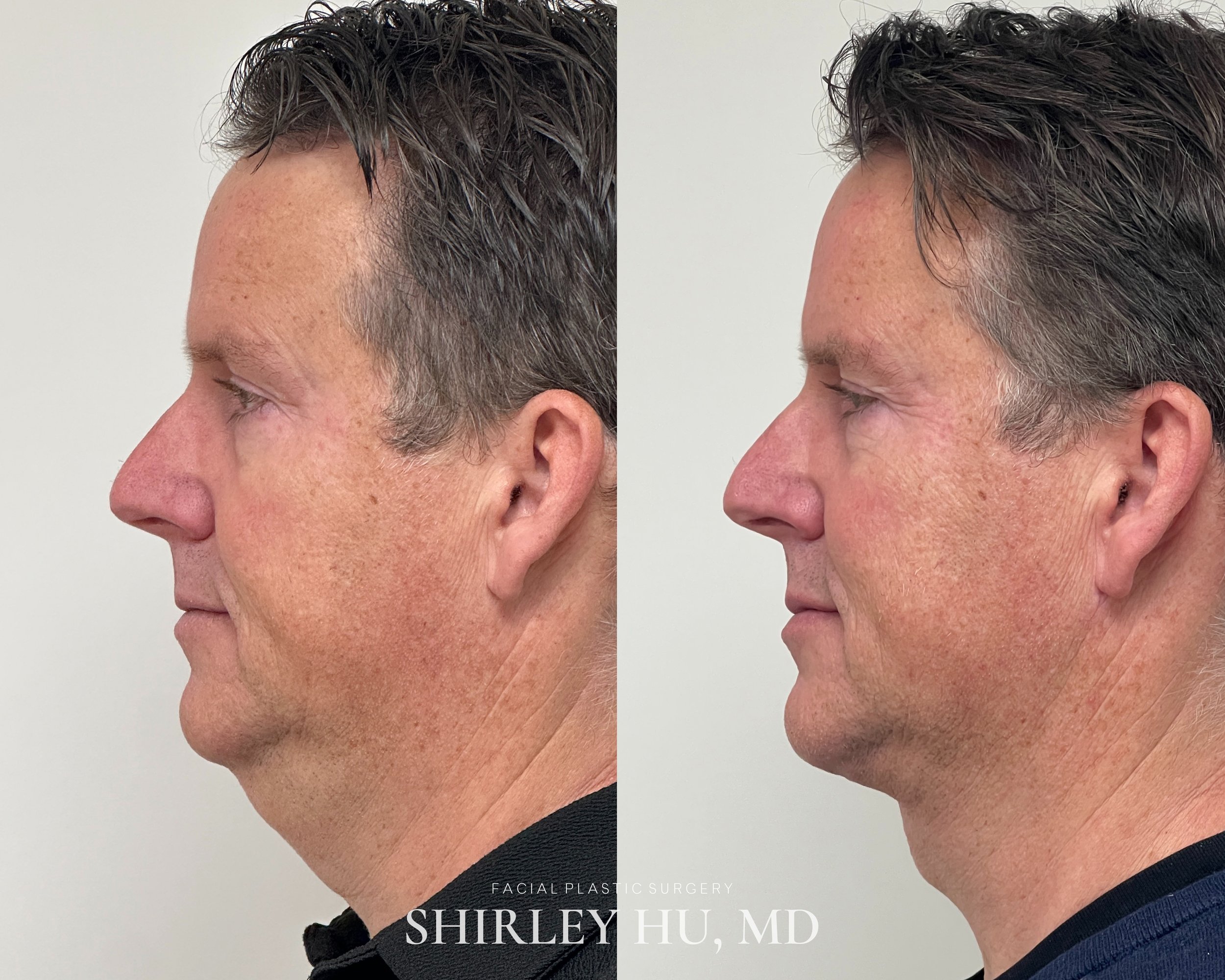 Deep neck lift, liposuction, and Renuvion neck skin tightening in a 54-year-old man