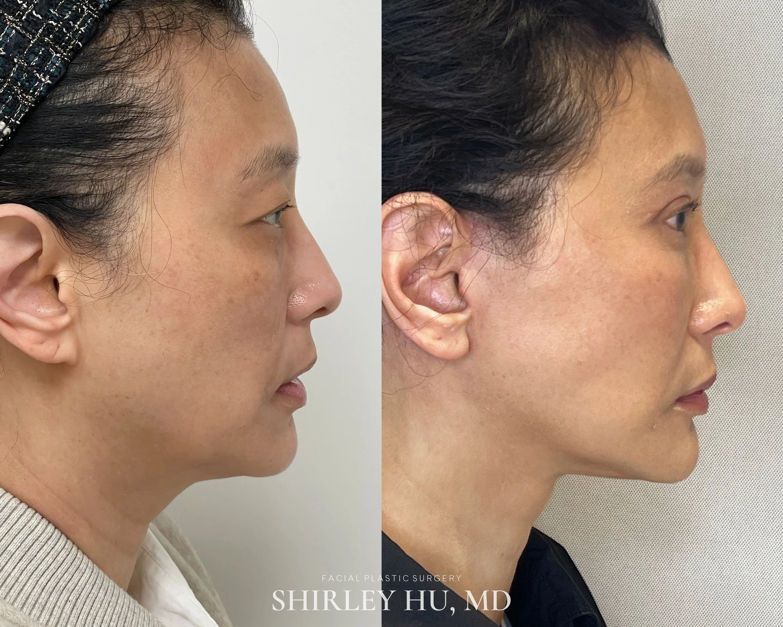 Facelift, neck lift, upper blepharoplasty, and lower blepharoplasty in a 49-year-old woman