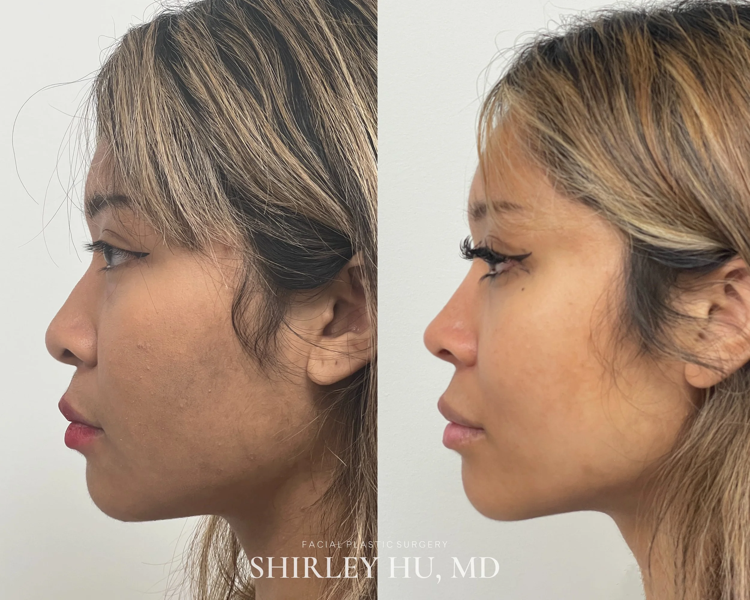 Primary rhinoplasty in a 22-year-old woman