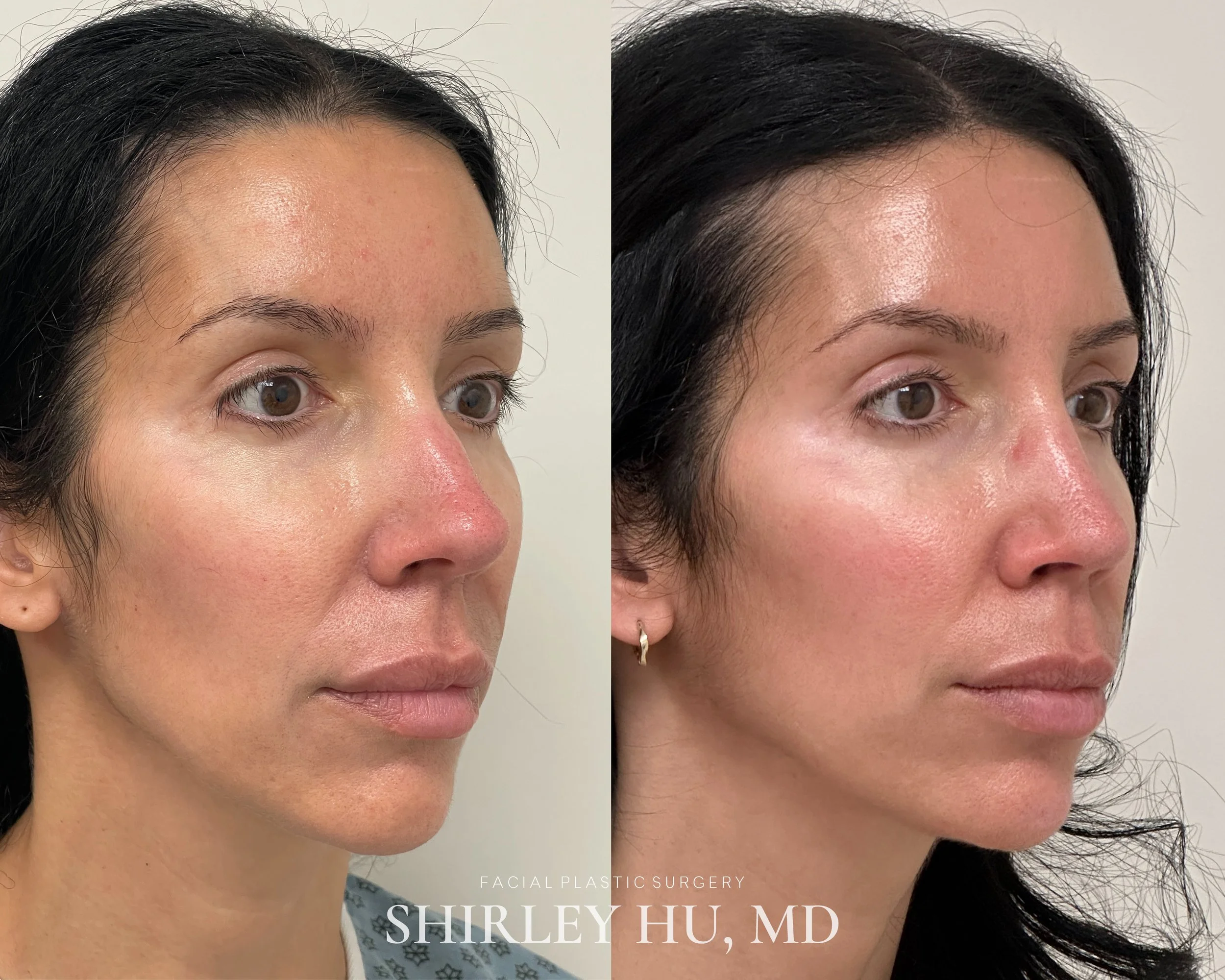 Primary rhinoplasty in a 42-year-old woman 