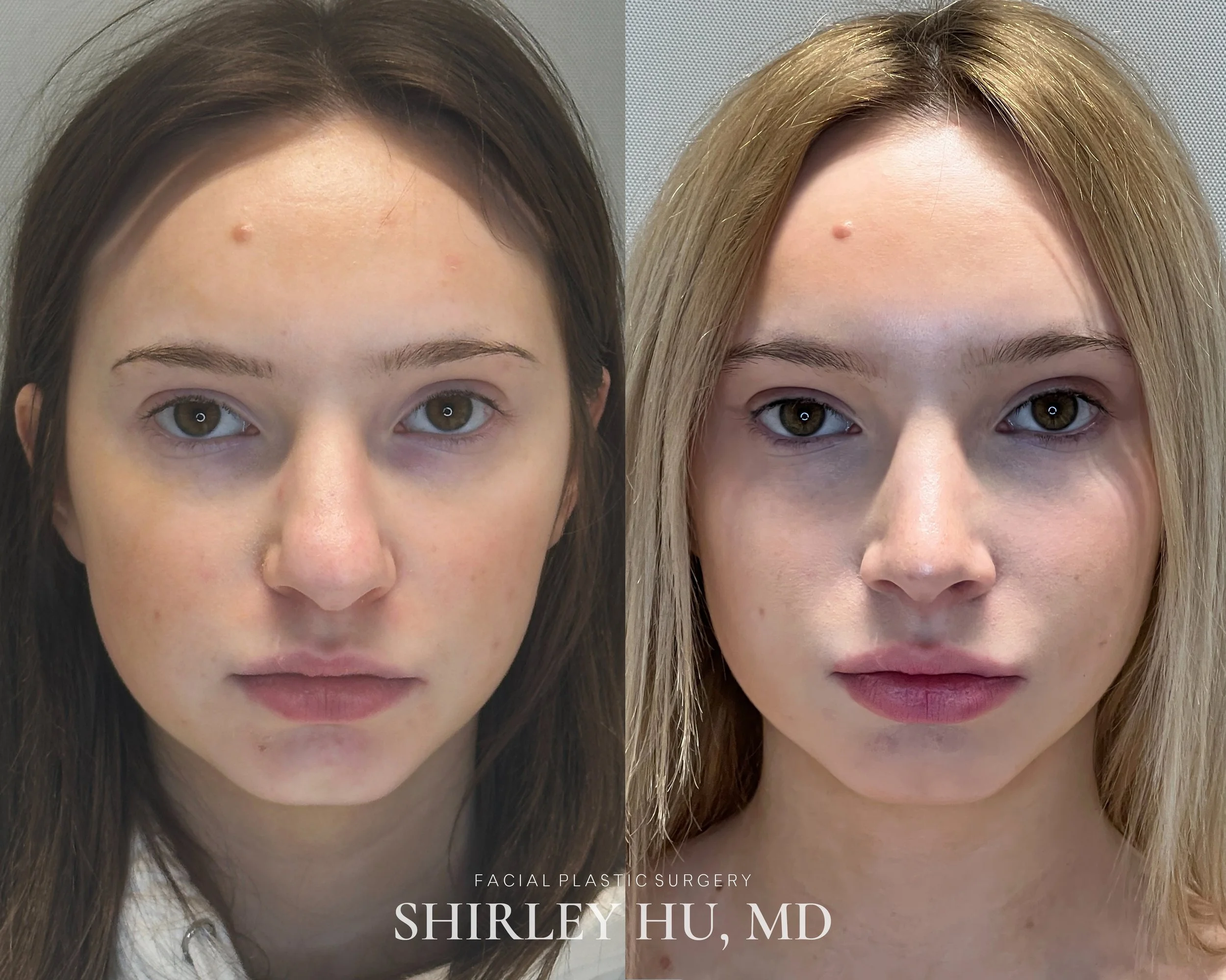 Primary rhinoplasty in an 18-year-old woman