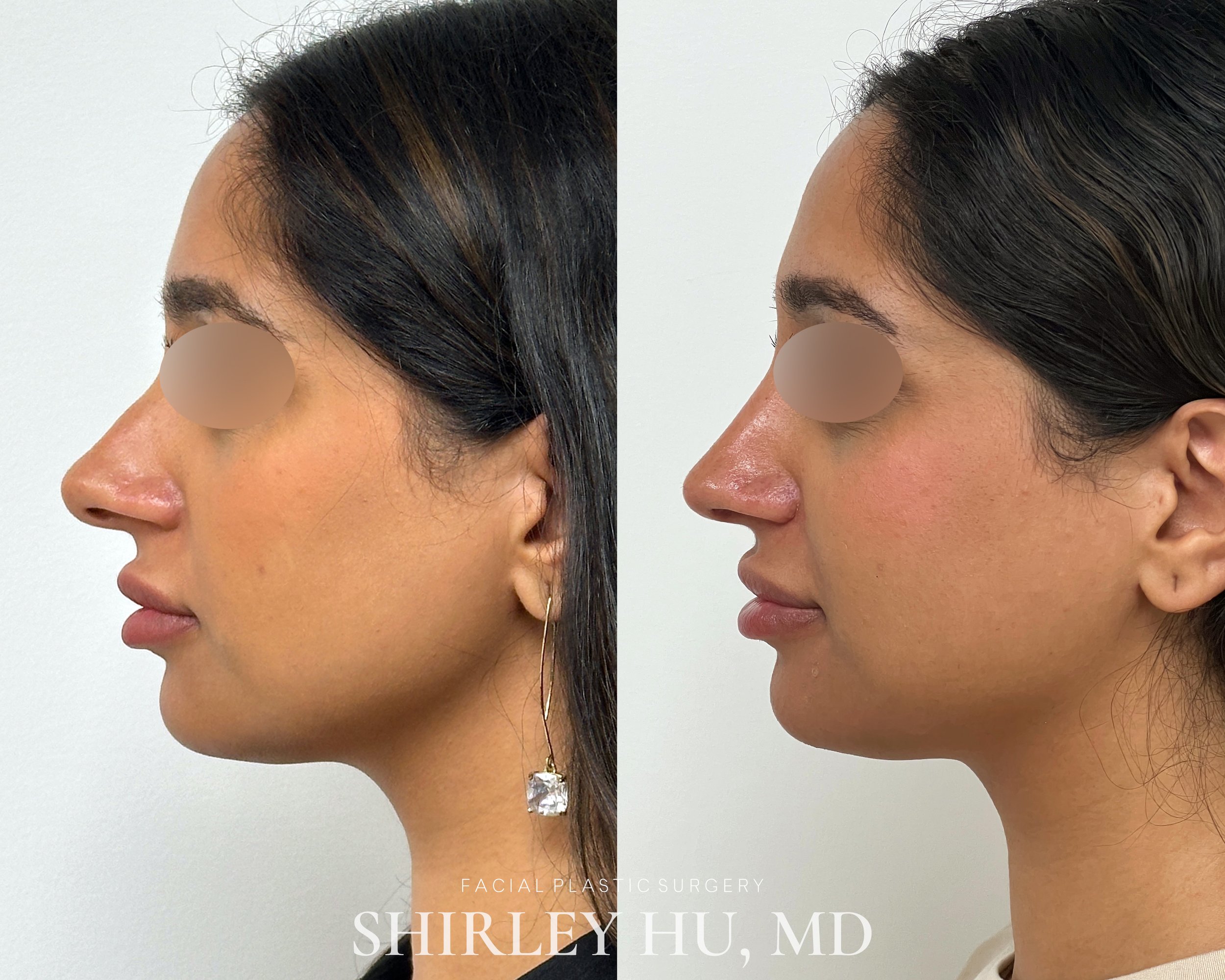 Primary rhinoplasty in a 30-year-old woman