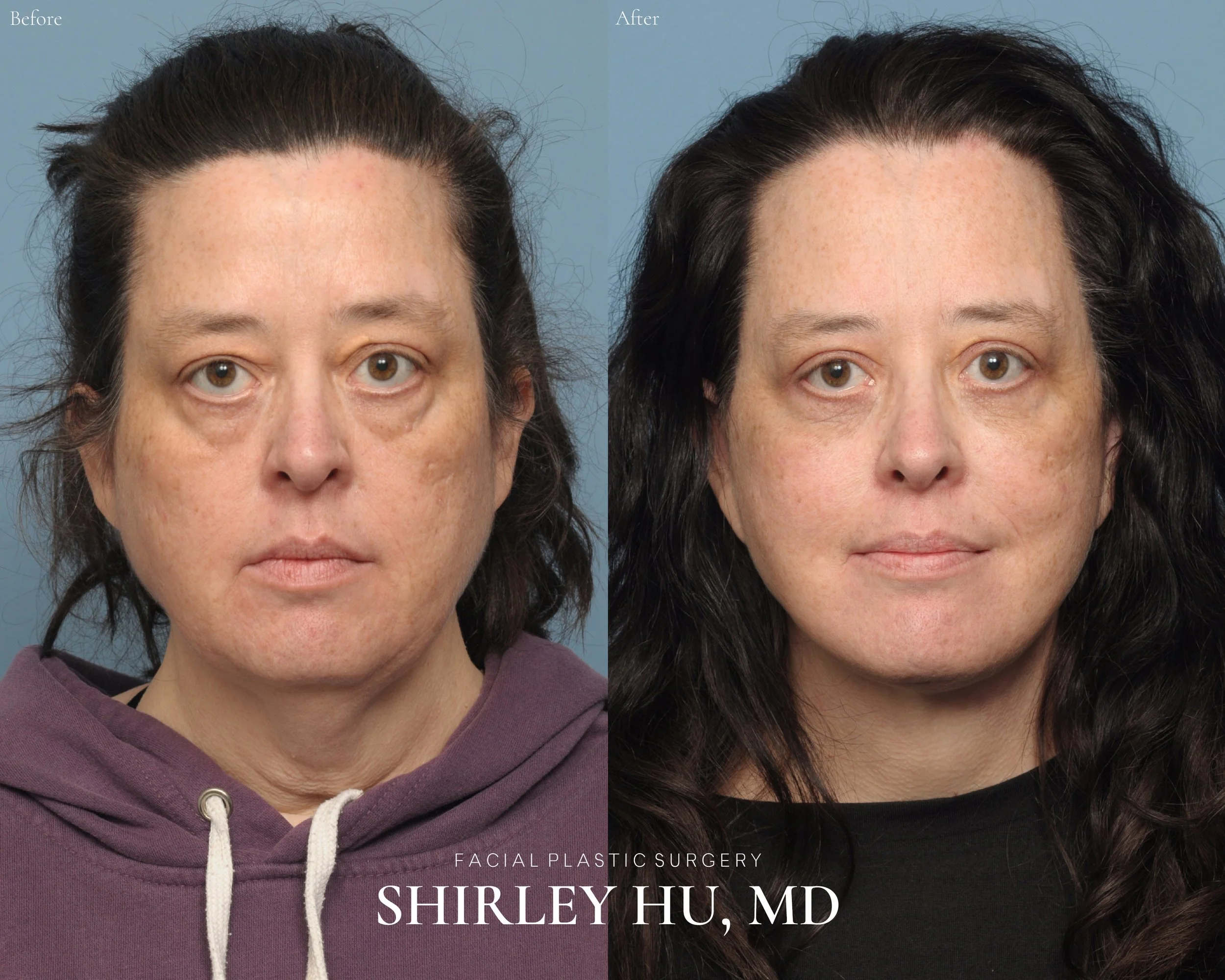 Upper and lower blepharoplasty, facelift, and neck lift in a 54-year-old woman