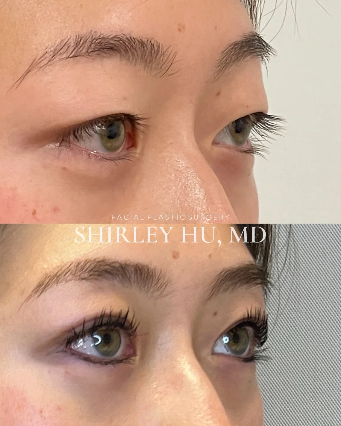 Incisional double eyelid surgery in an 18-year-old female