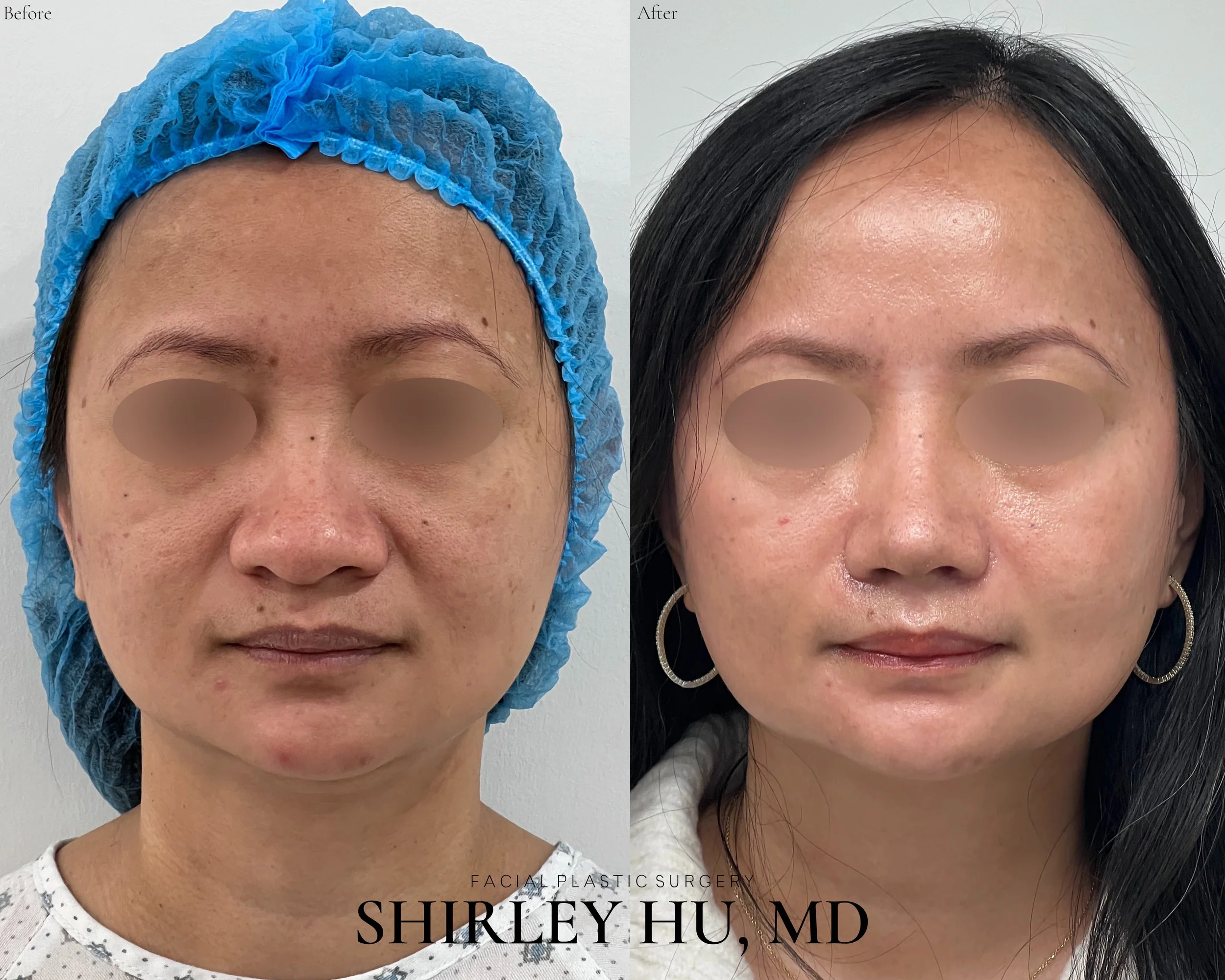 Primary rhinoplasty with rib cartilage in a 45-year-old woman