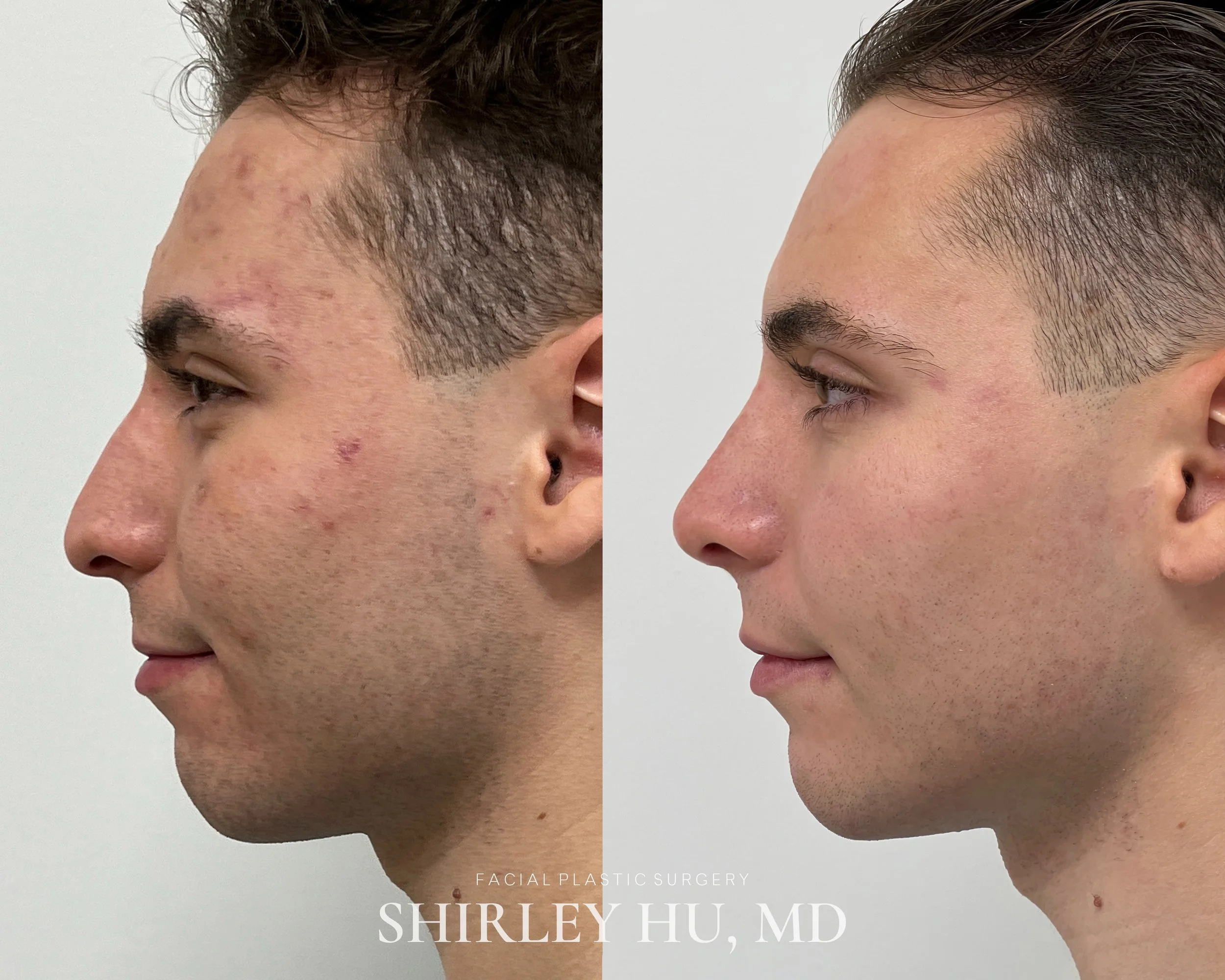Primary rhinoplasty in a 20-year-old male