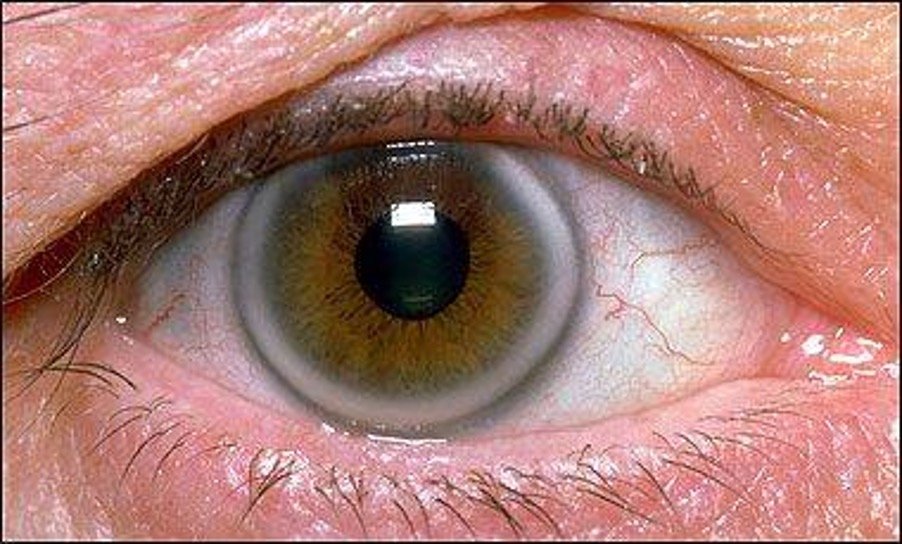 Bijproduct fluiten Filosofisch Arcus Senilis (corneal arcus) – What is it? — Arthur Hayes Opticians, East  Grinstead