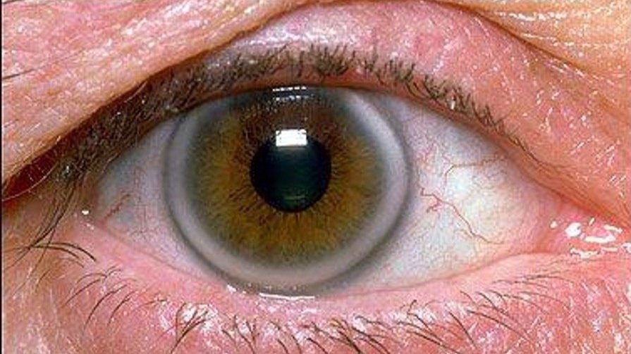 Arcus Senilis (corneal arcus) – What is it? — Arthur Hayes Opticians, East Grinstead