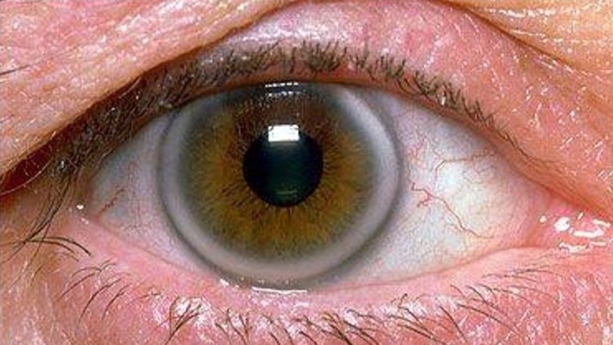 Will Corneal Transplant Leave You With Poor Vision?