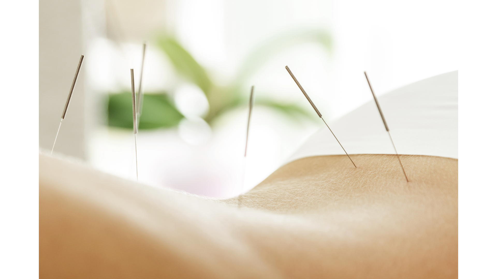 Introducing Classical Acupuncture