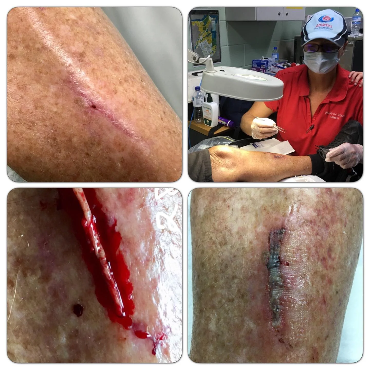 A little bit of work done on it, with a little bit of love put in it. All this in 7 weeks!!
Olympic Official, healed!!
Any athletic war stories to share?
&bull;
#tracksidemedic #sportsmedicine #ilovemyjob #sportspodiatry #injurymanagementforathletes