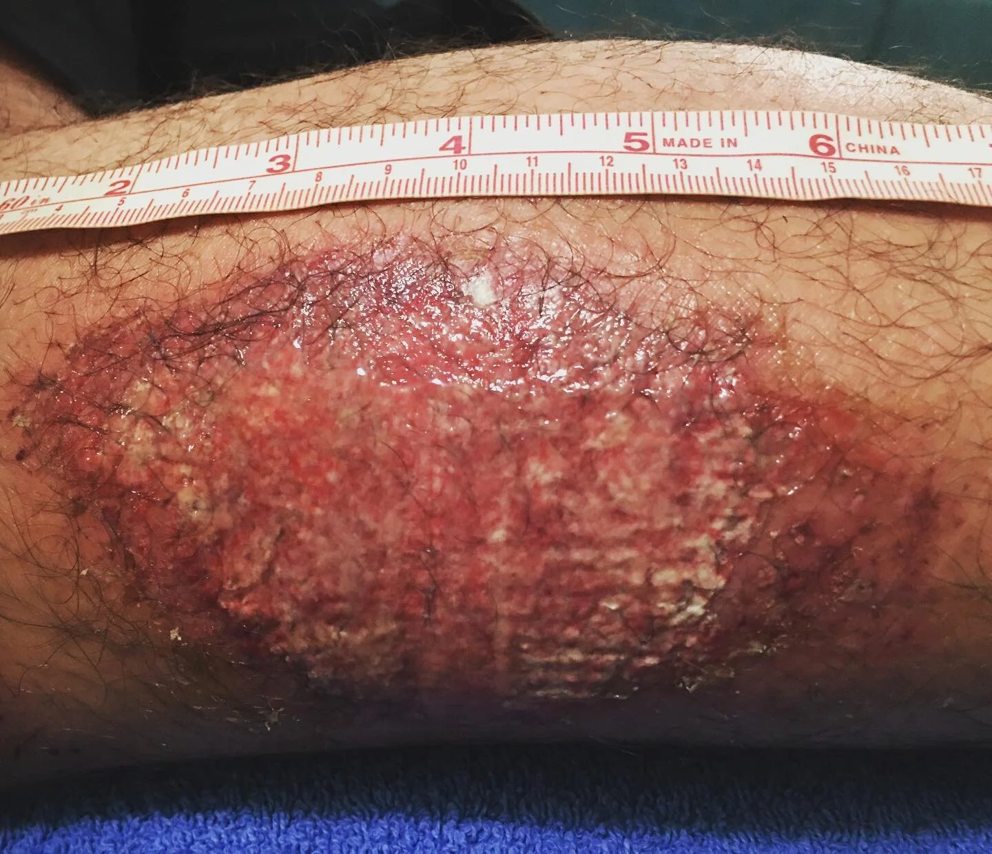 Warning: Sensitive Viewing 

Case Study: A 28yo male ⚽️ Football player presents limping with a sore hamstring 2 days post. H/S was tested as +ve to a 2nd-3rd degree tear. My observations and testing were confirmed with a diagnostic ultrasound. 
L: 1